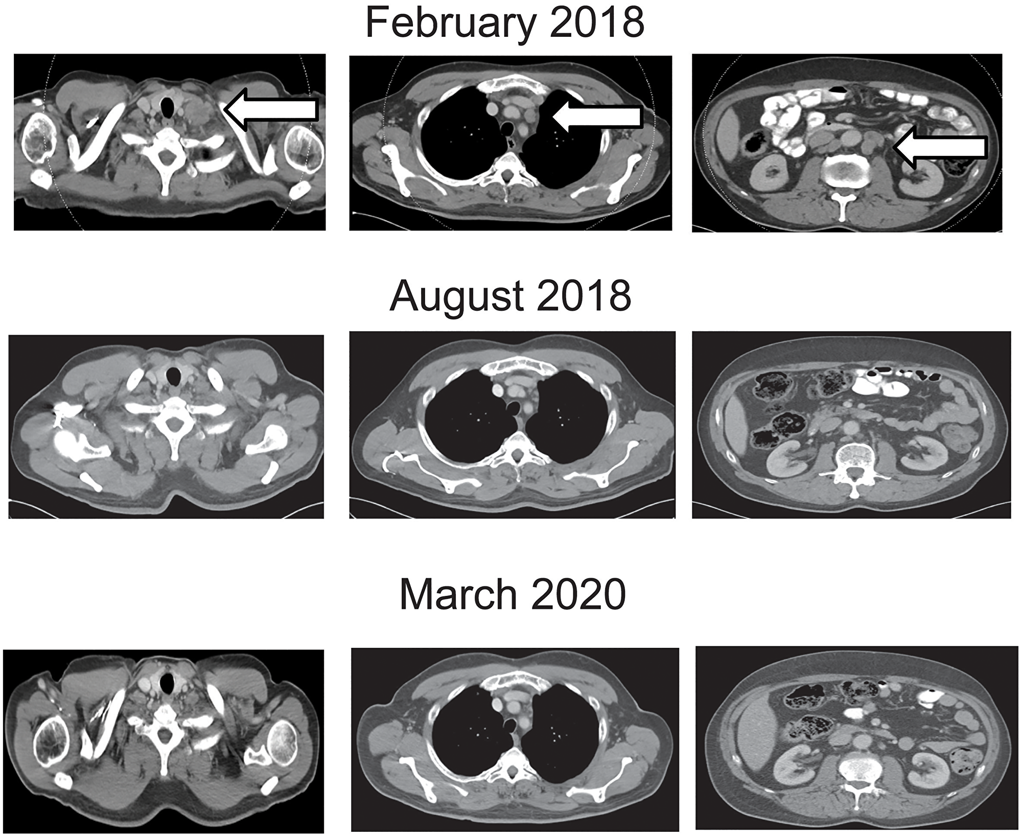 Contrast enhanced computed tomography of the chest and abdomen at beginning, during and at the end of nivolumab treatment