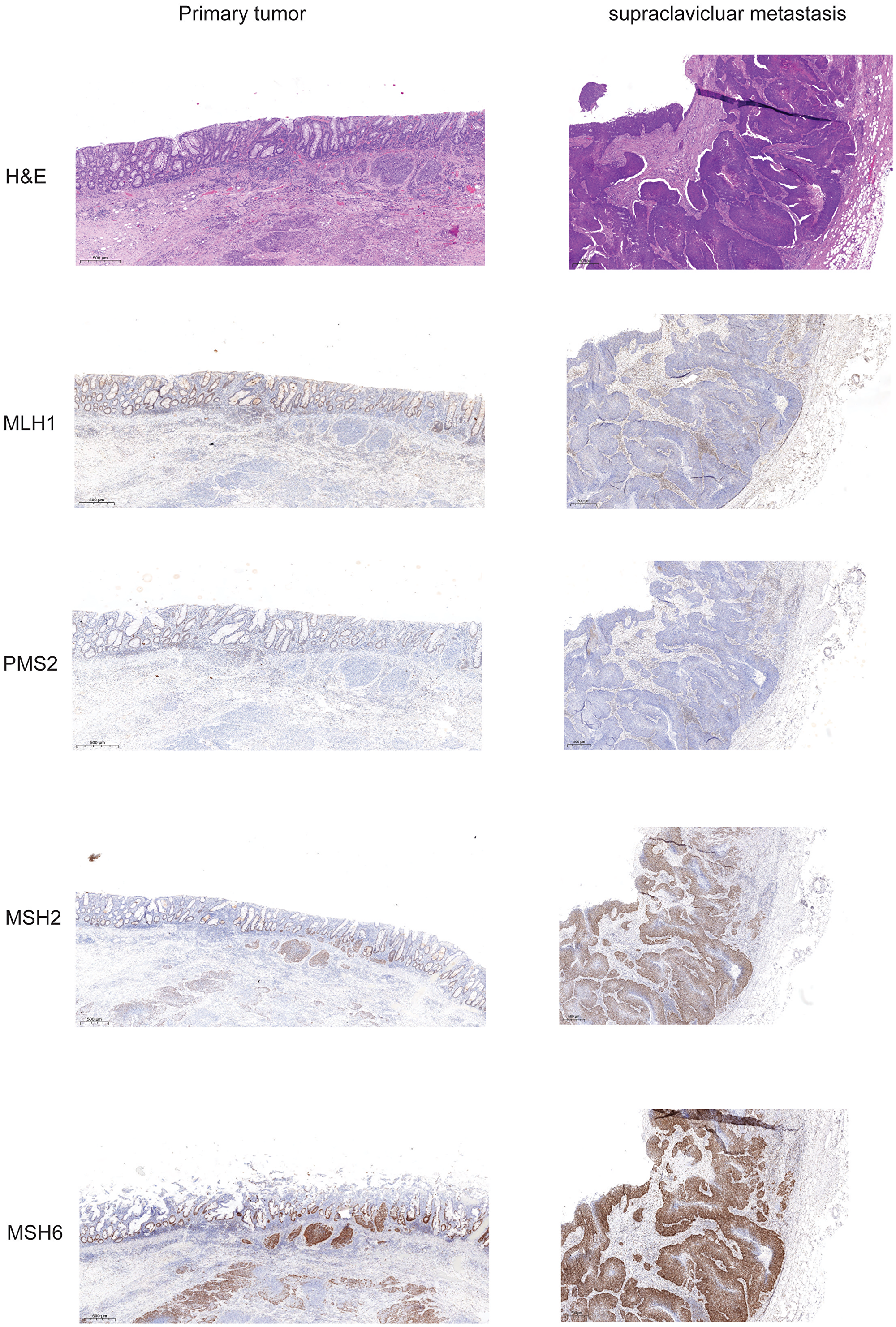 Expression of mismatch repair proteins in primary tumor and supraclavicular metastasis