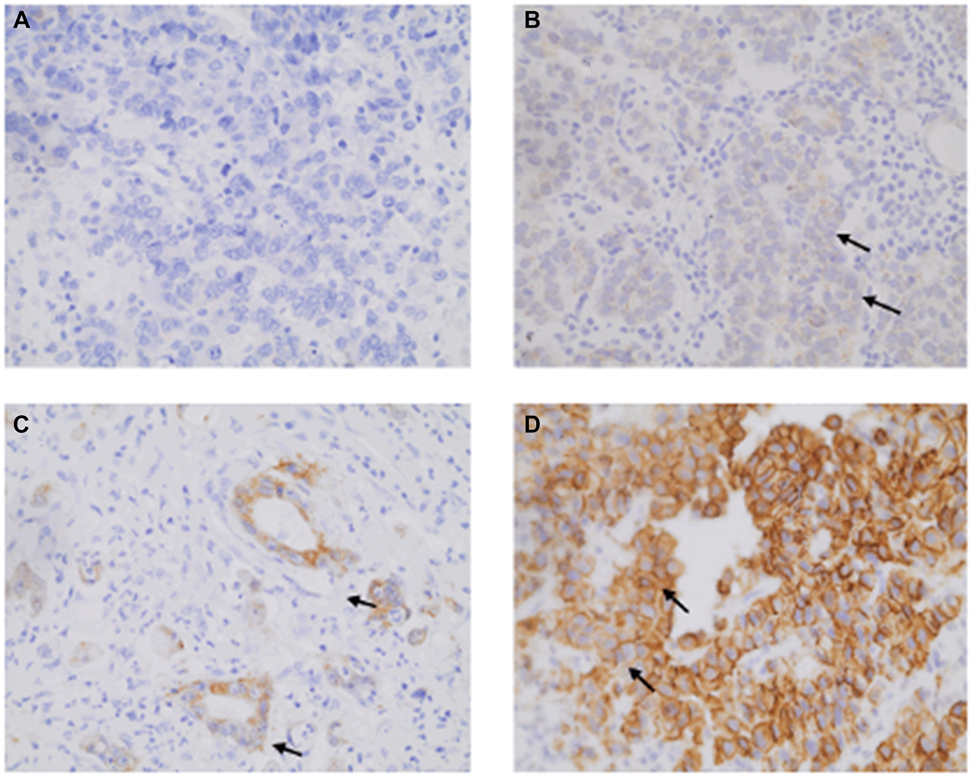 Illustrative HER2 immunohistochemistry labeling observed for gastric adenocarcinoma (GA) patients at 400× magnification