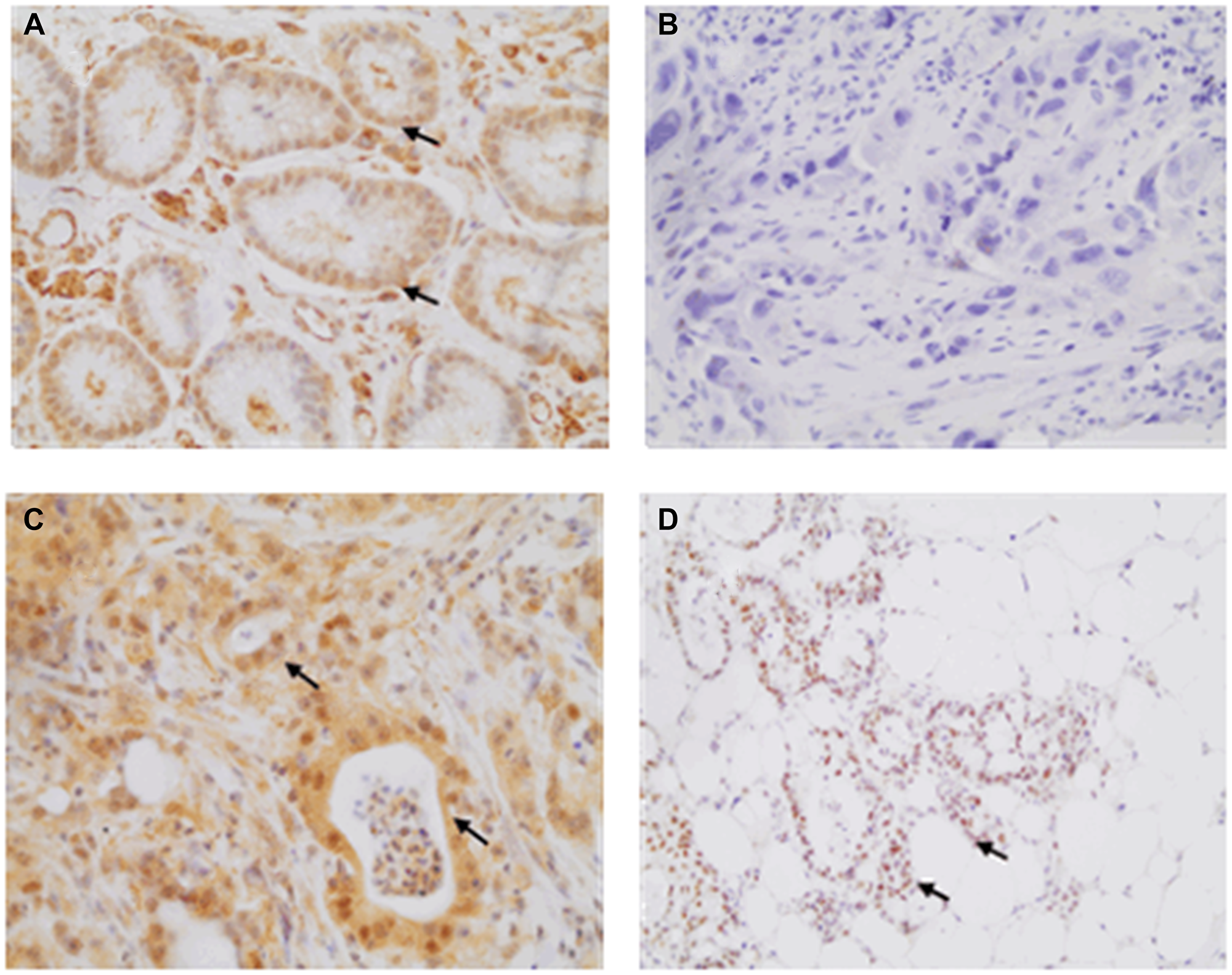 Illustrative HIF-1 immunohistochemistry labeling observed at 400× magnification for gastric samples