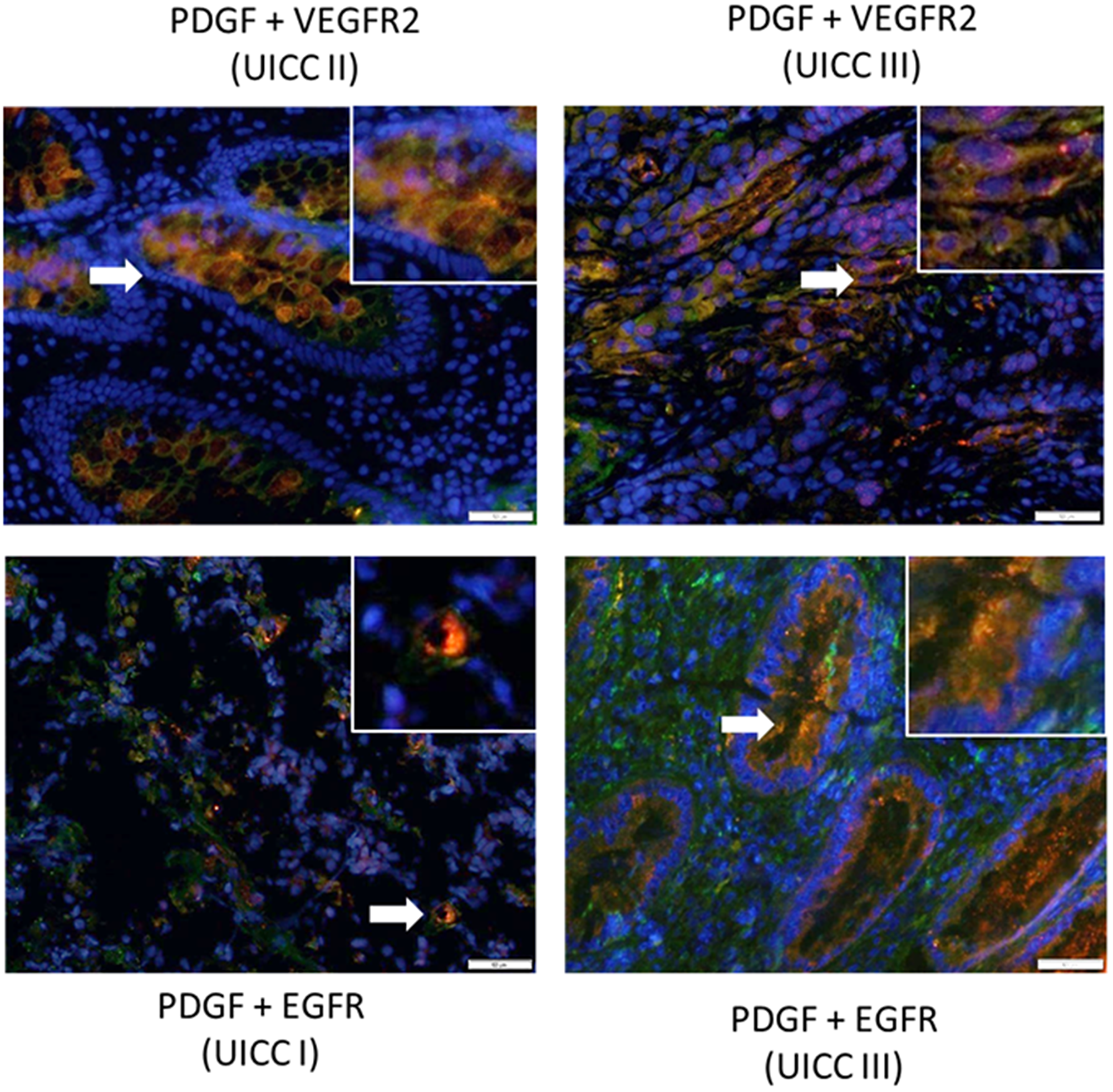 Co-expression of PDGF with VEGFR2 and EGFR in human colon cancer