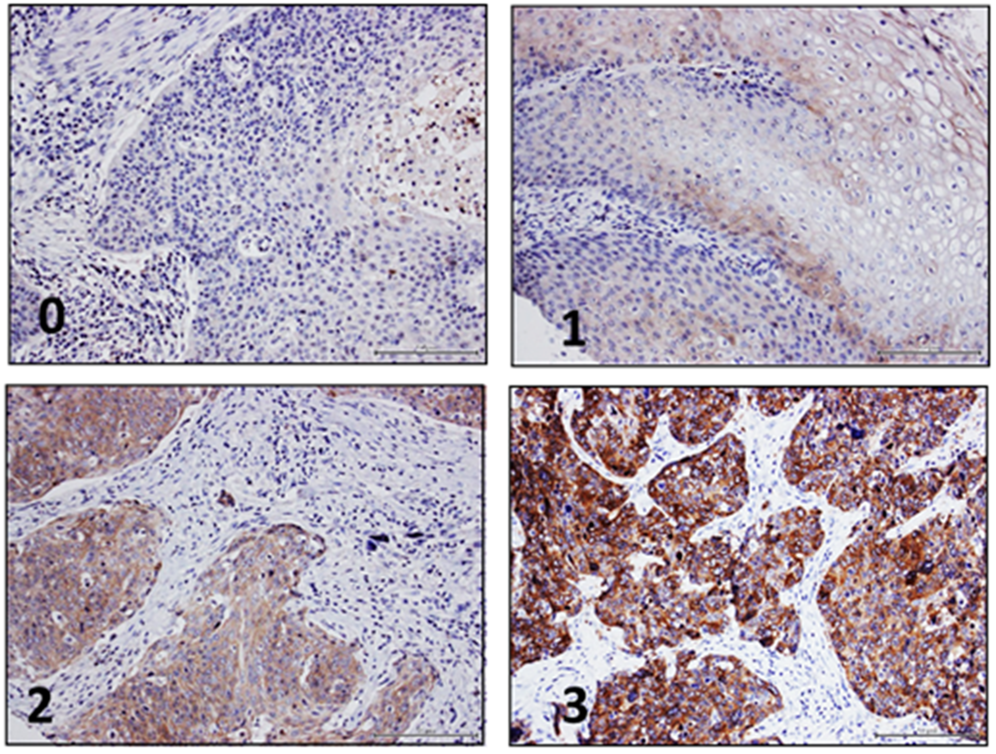 Nectin-4 immunohistochemistry in HNSCC
