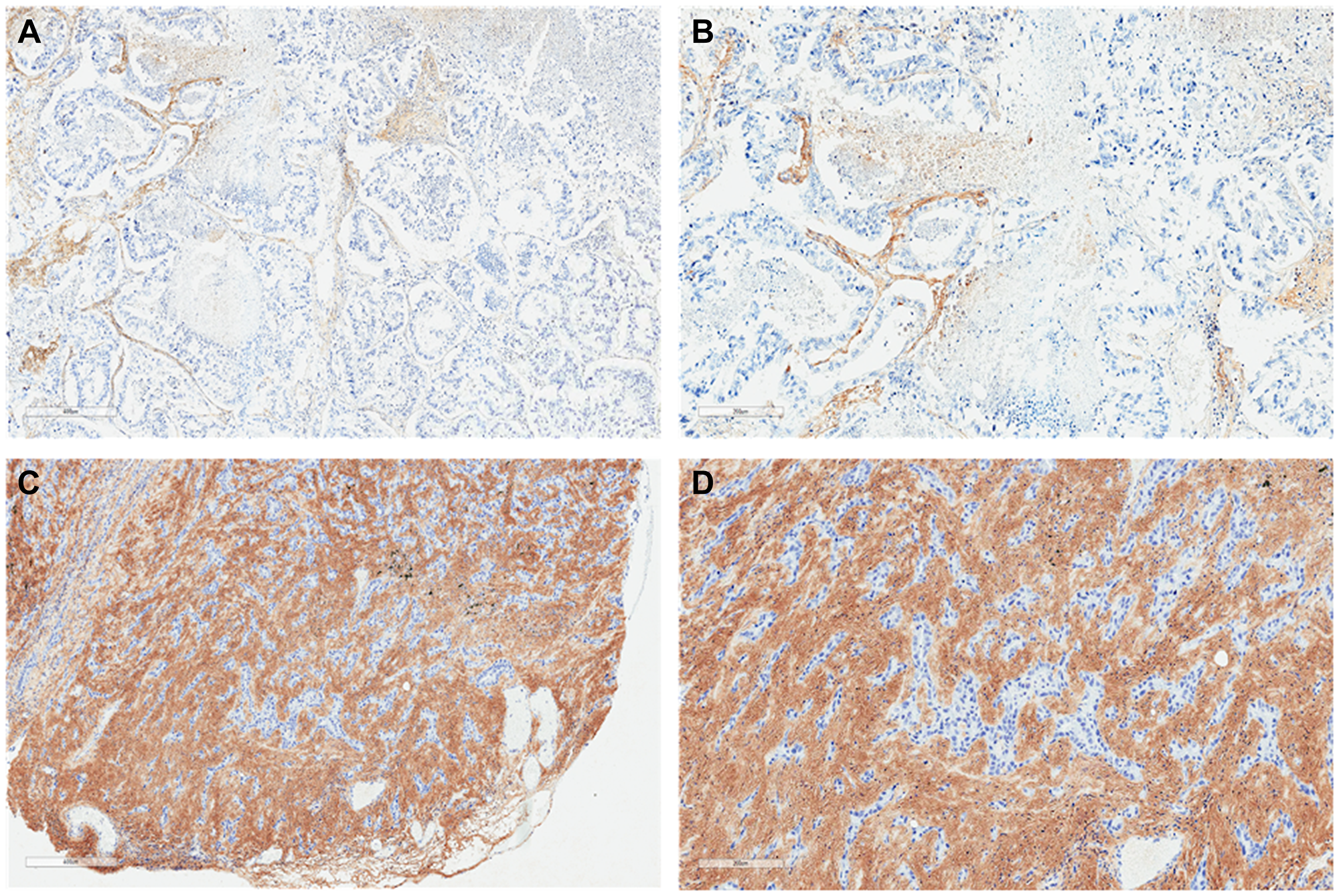 Lung adenocarcinoma histochemistry