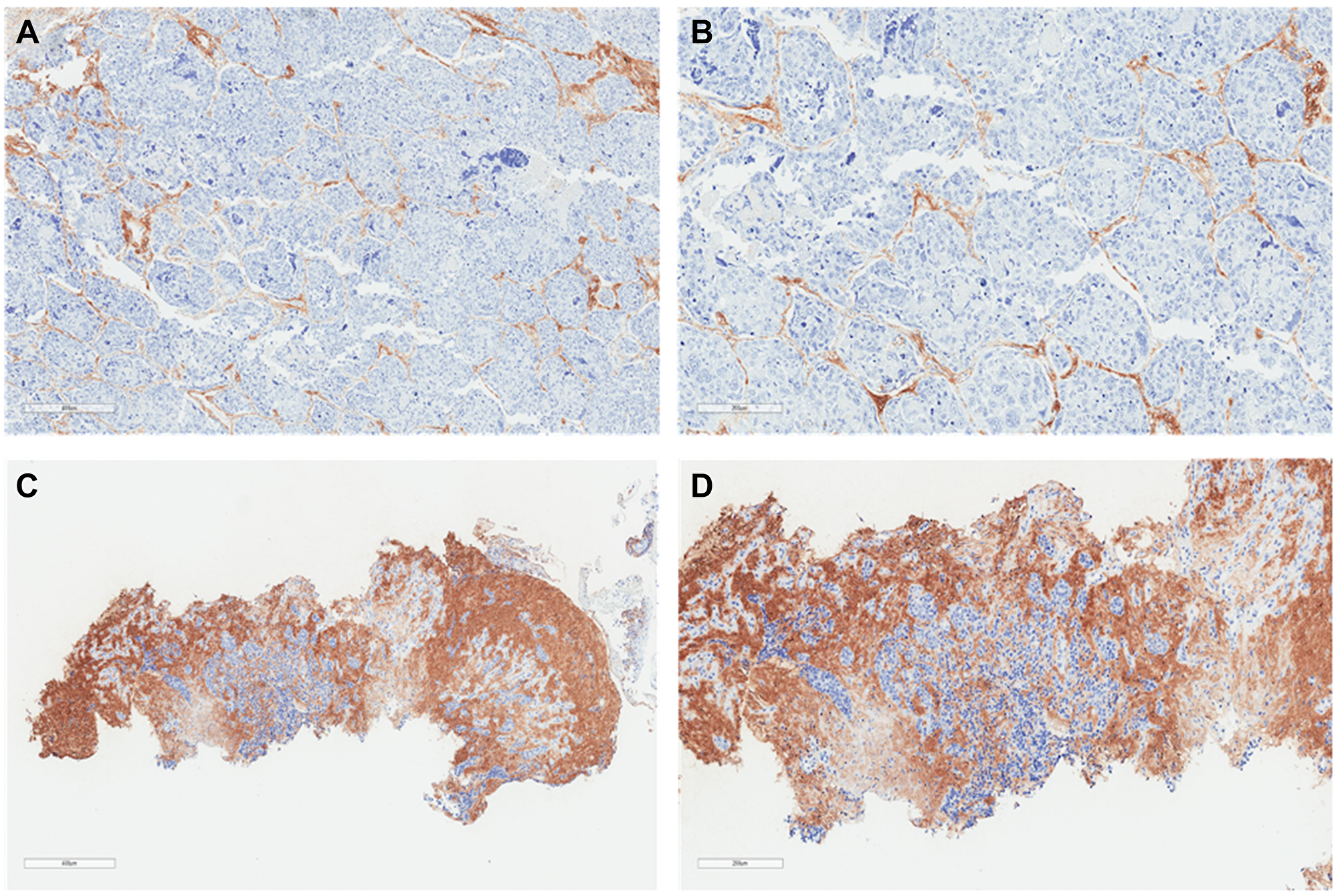 Lung squamous cell carcinoma histochemistry