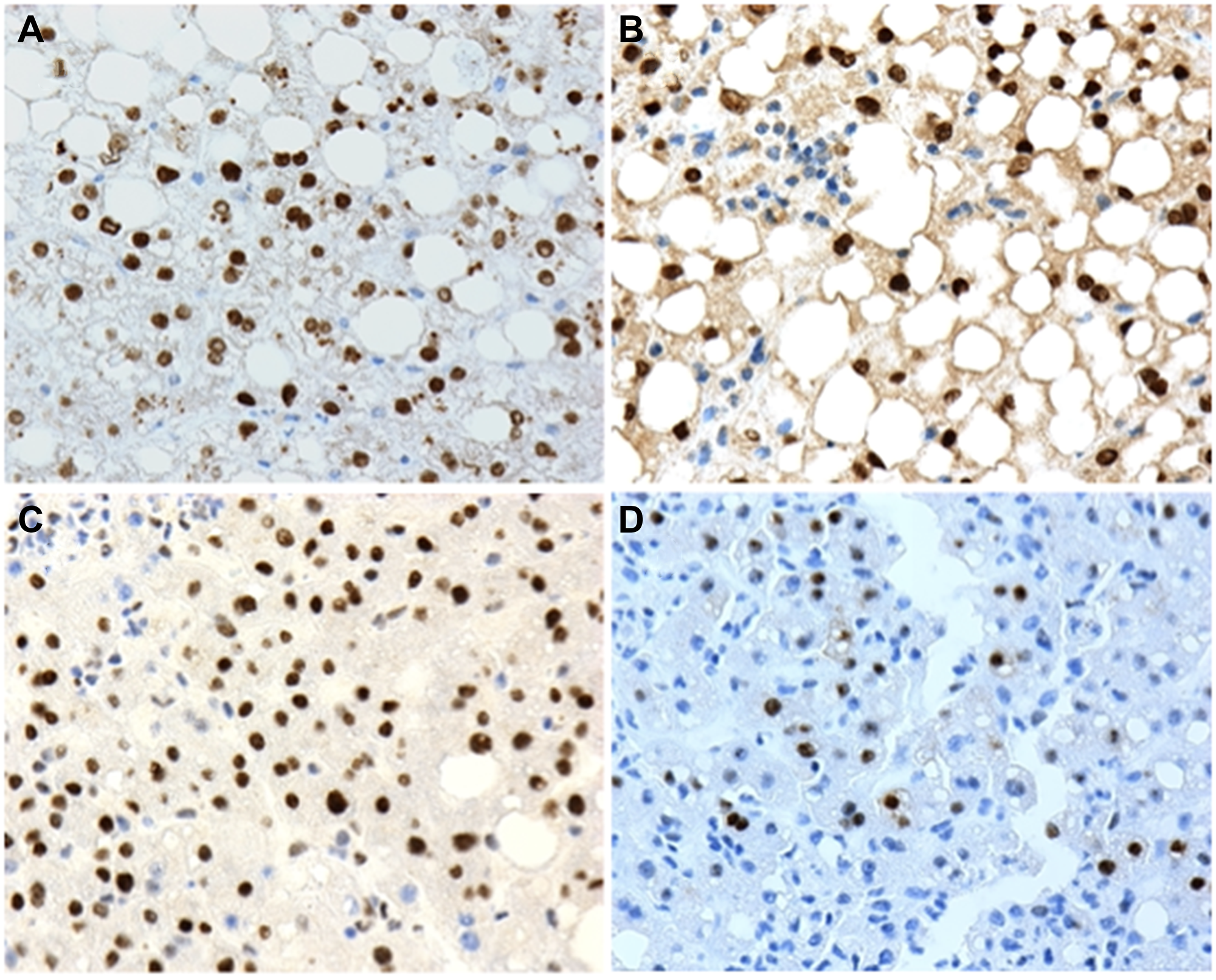 Examples of positive nuclear expression of (A) P1-HNF4α; (B) P2-HNF4α; (C) p-STAT3 and (D) c-Myc and human liver biopsies with non-alcoholic fatty liver disease (NAFLD). 20X microscope objective.