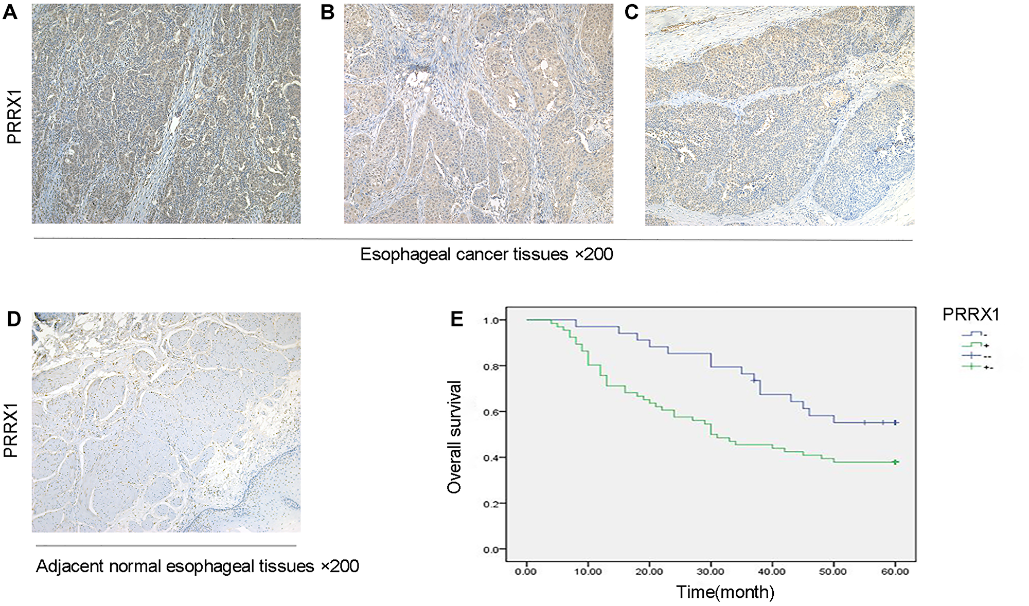 PRRX1 expression is upregulated in oesophageal cancer and related to shorter overall survival