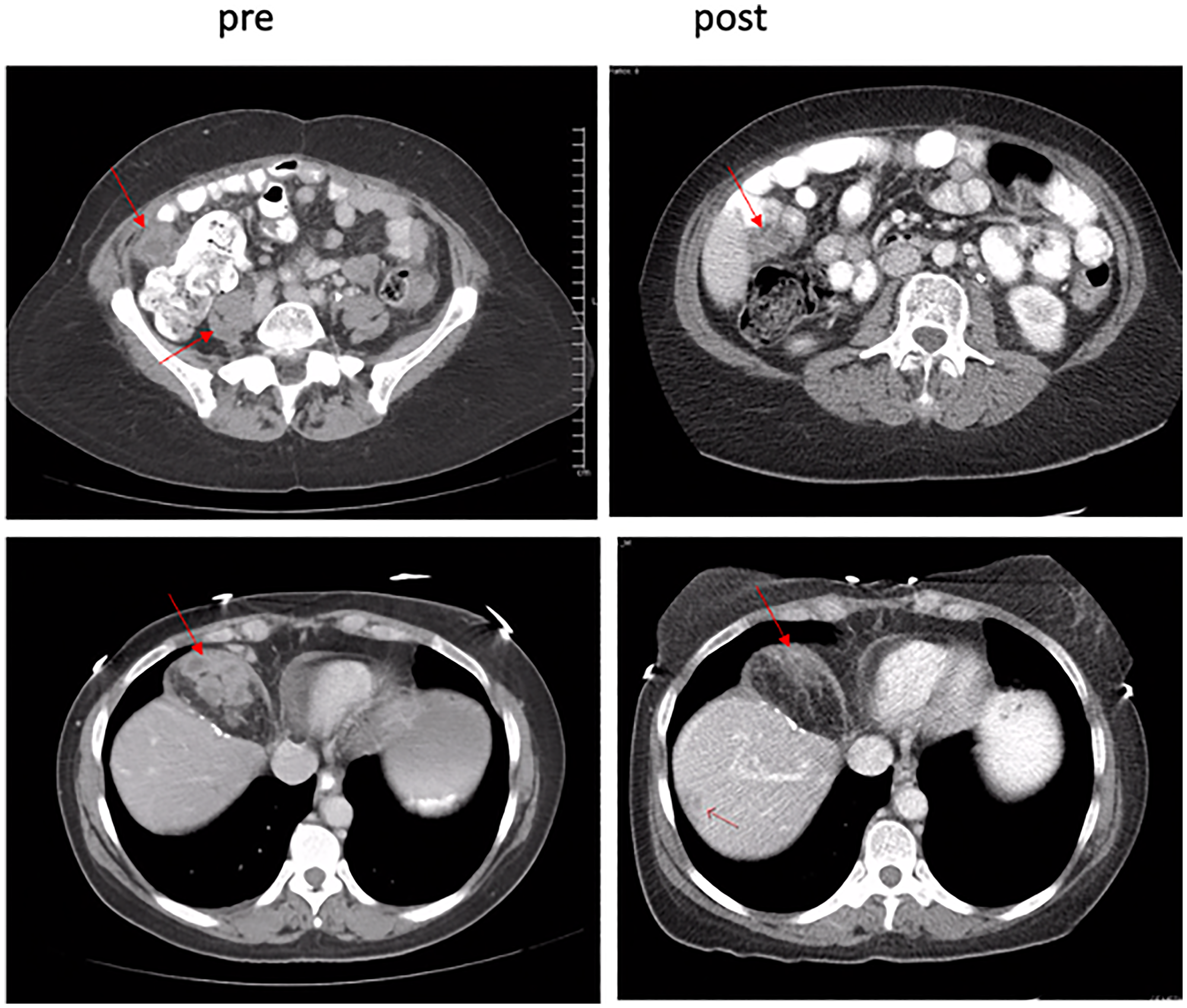 Pre- and post-treatment scans confirmed partial responder