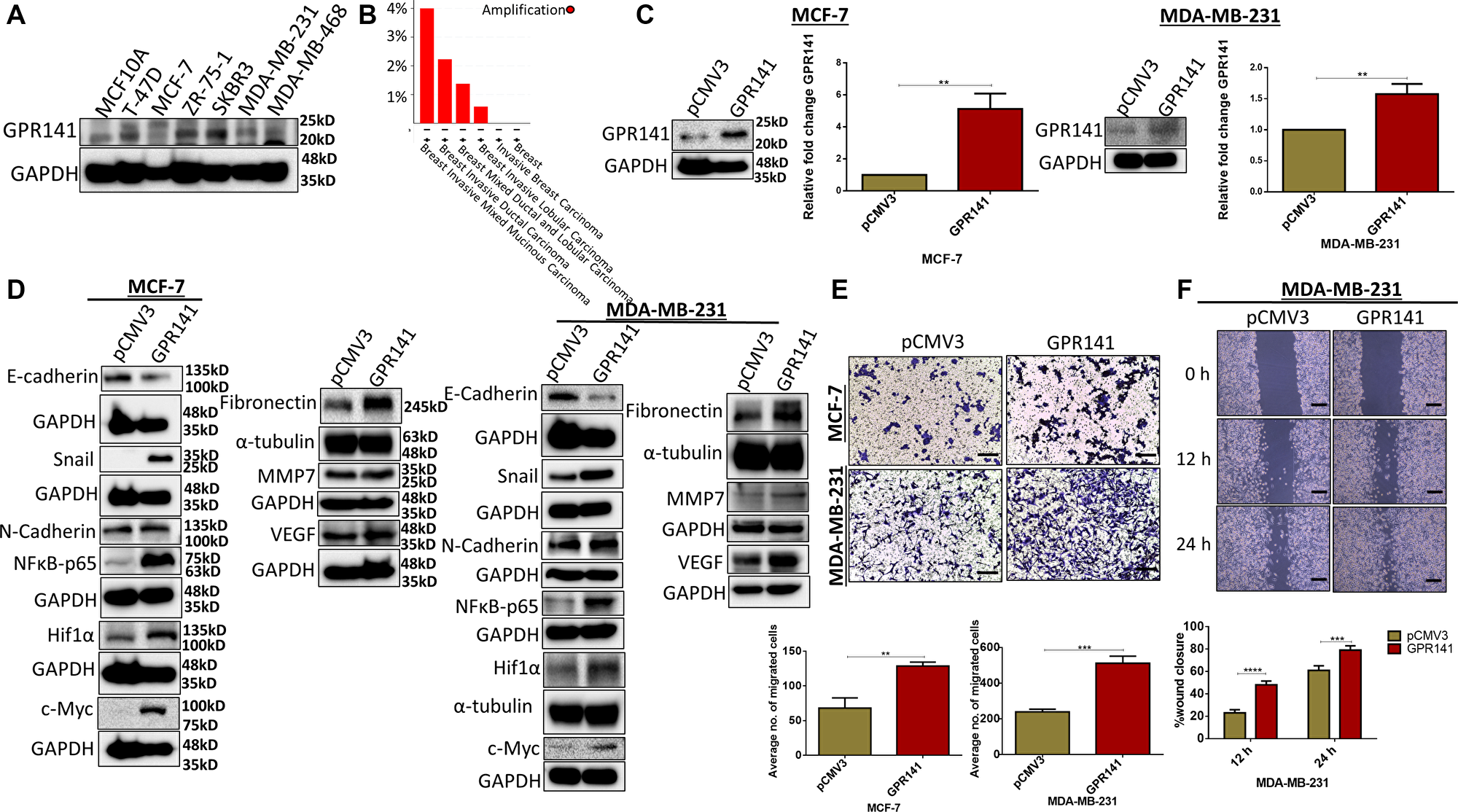 GPR141 overexpression in breast carcinoma induces the expression level of oncogenic mediators and EMT markers and influences tumor niche in vitro