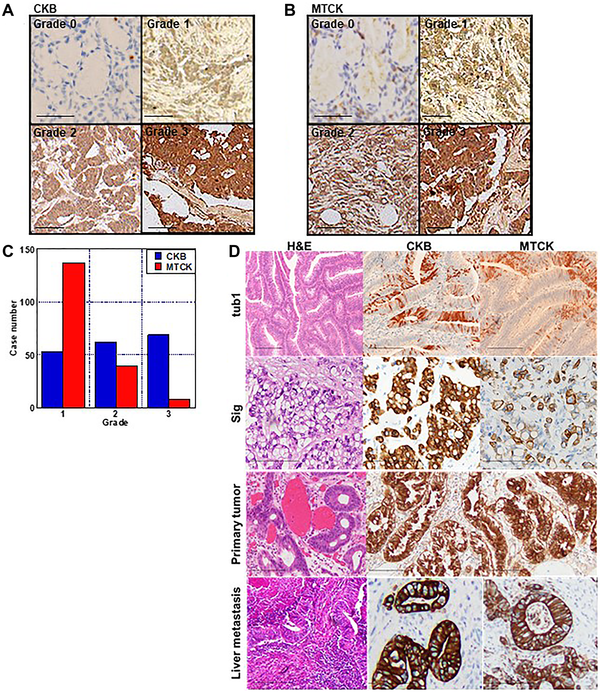 Immunohistochemistry of CKB and MTCK in CRCs