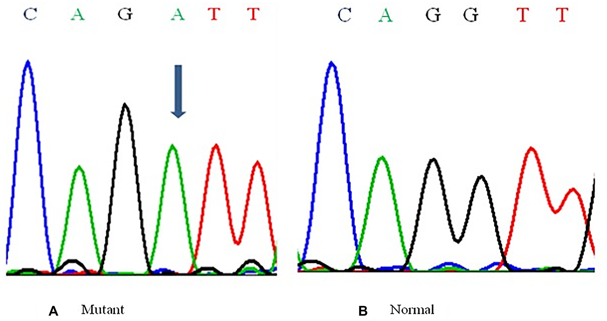 Representative Partial electropherograms of Mutant (A) (shown by arrow) with Normal (B) adjacent forms for the BORIS gene showing G$!--ESC