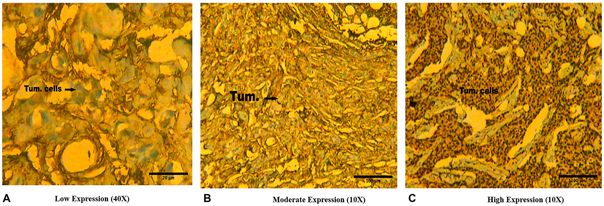 Representative immunohistochemical slides showing (A) Low protein expression (+) (scale bar 20 μm), (B) Moderate protein expression (++) (scale bar 100 μm), and (C) High protein expression (+++) (scale bar 100 μm) of BORIS protein in Indian female breast cancer cases.