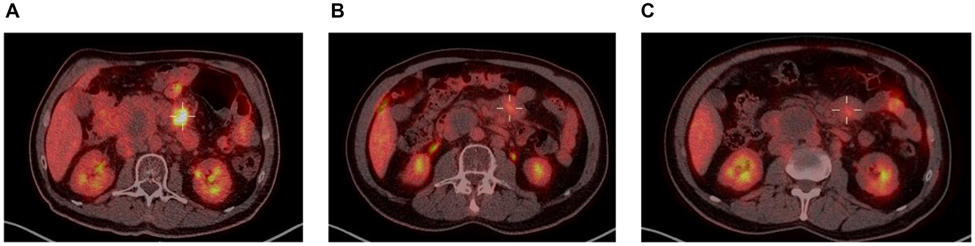 PET scan at screening (A), 5 months (B) and 8 months on treatment (C).