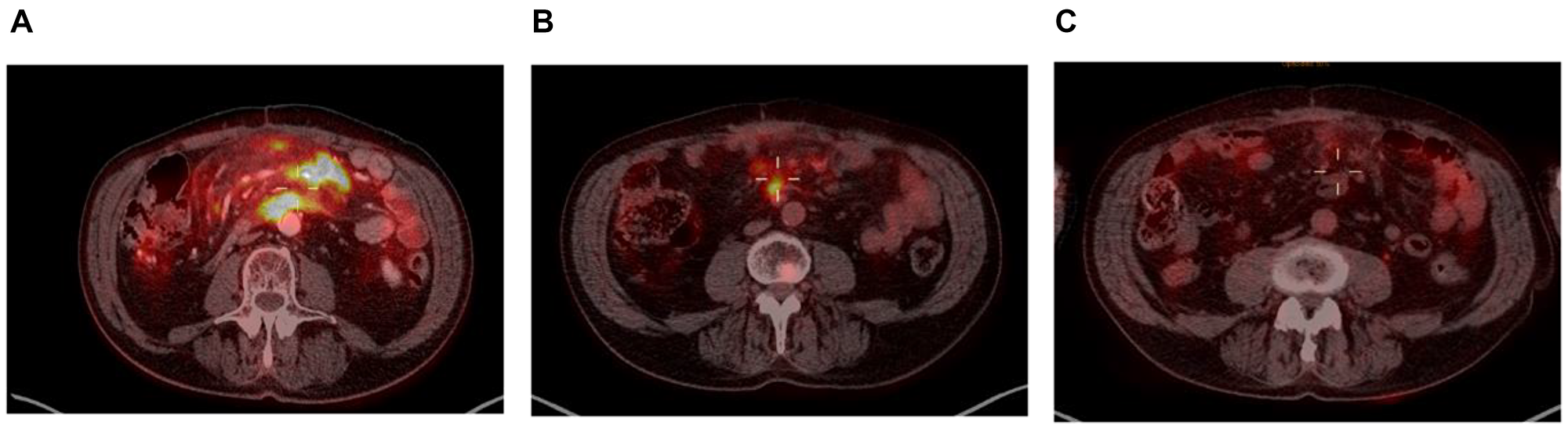 PET scan at screening (A), at 6 months (B) and at 7 months (C).