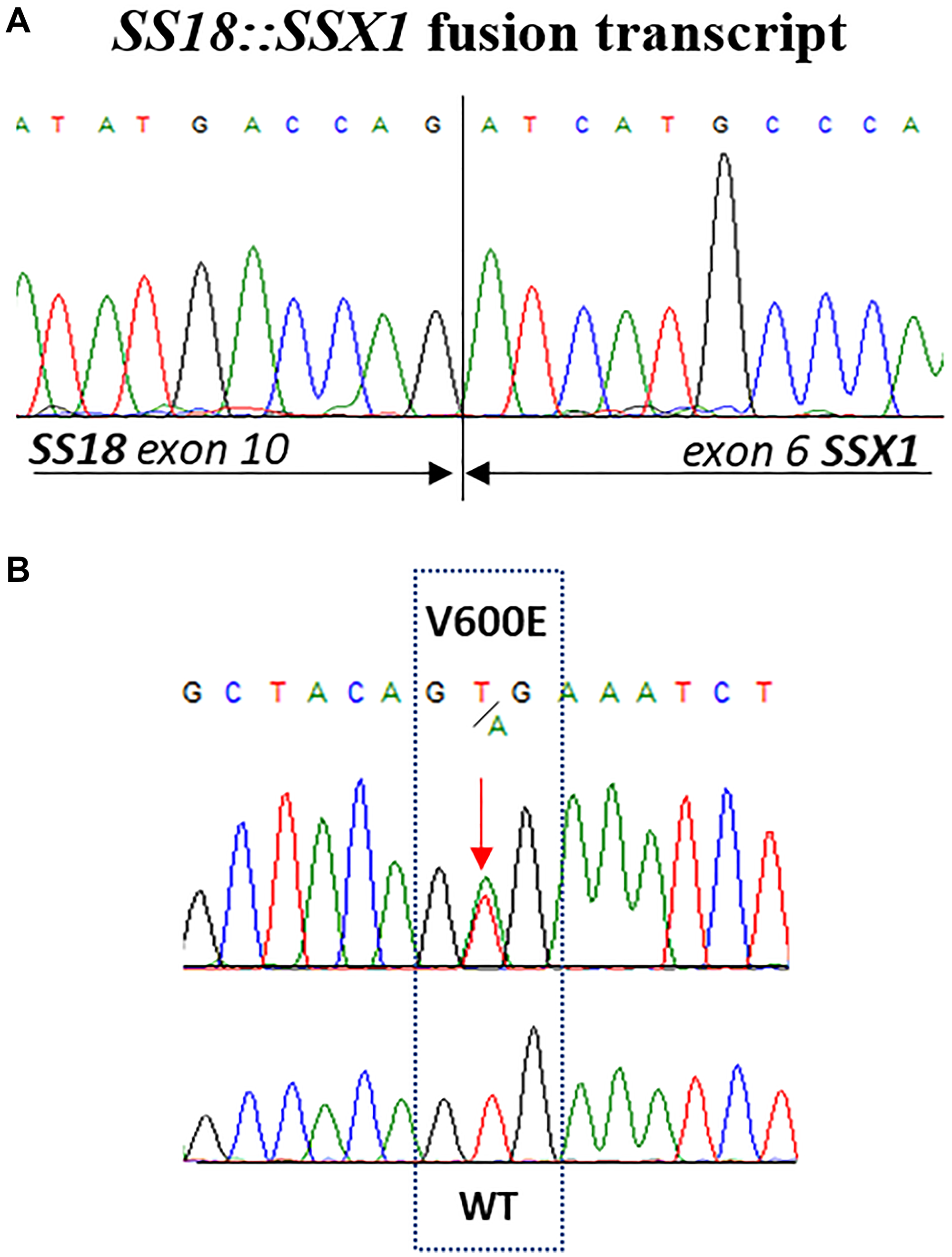 (A) Sequence analysis of SYT-SSX transcripts obtained from synovial sarcoma biopsy. (B) Partial electropherogram showing the activating missense mutation in codon 600 of exon 15 (V600E) of BRAF gene identified in tumour resection of patient’s synovial sarcoma.