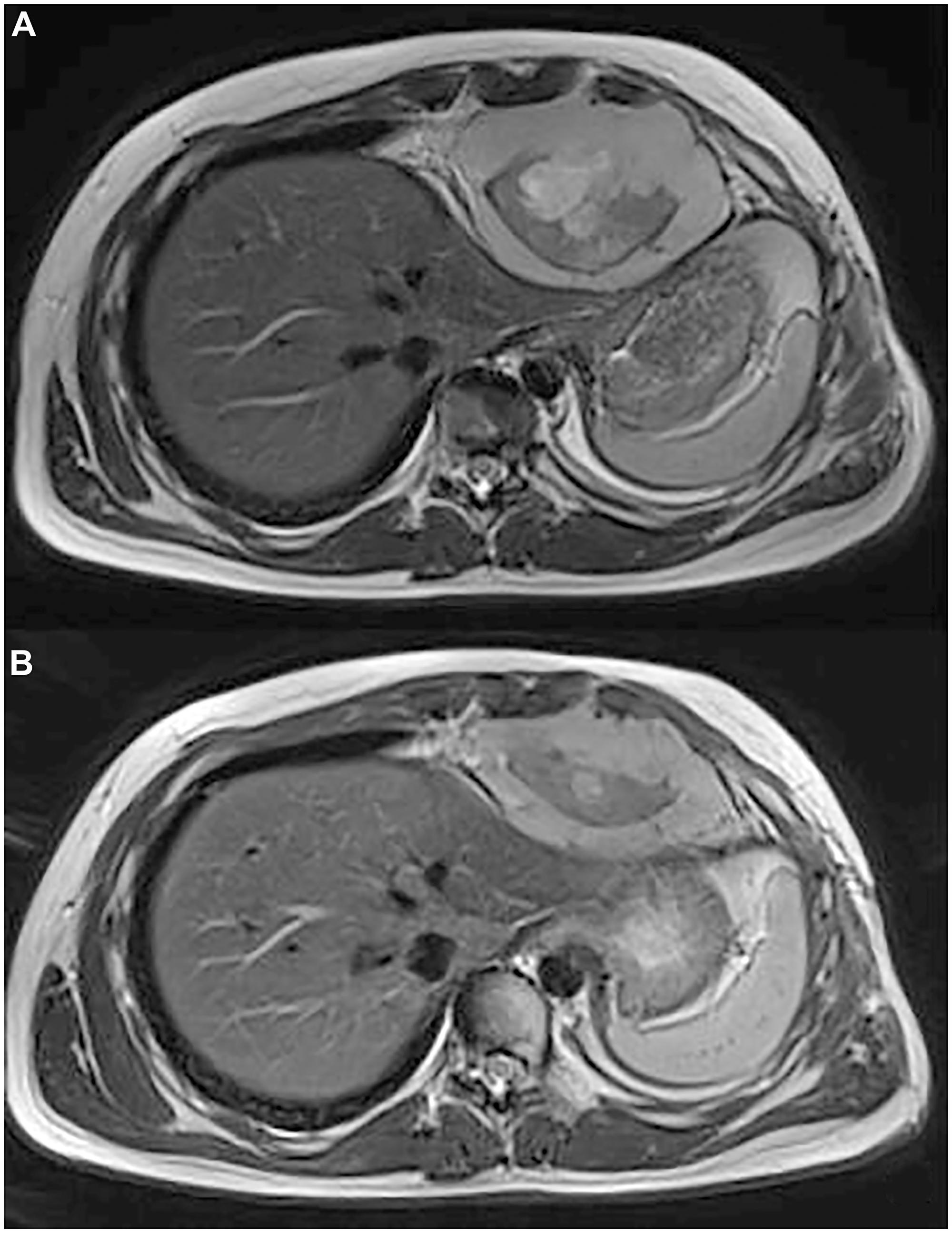 (A) Axial T2 MR shows a heterogeneous mass in the cardiophrenic space with evidence of anterior chest wall invasion and intercostal invasion. (B) Axial T2 MR shows 35 % of reduction in size of the mass in the cardiophrenic space.