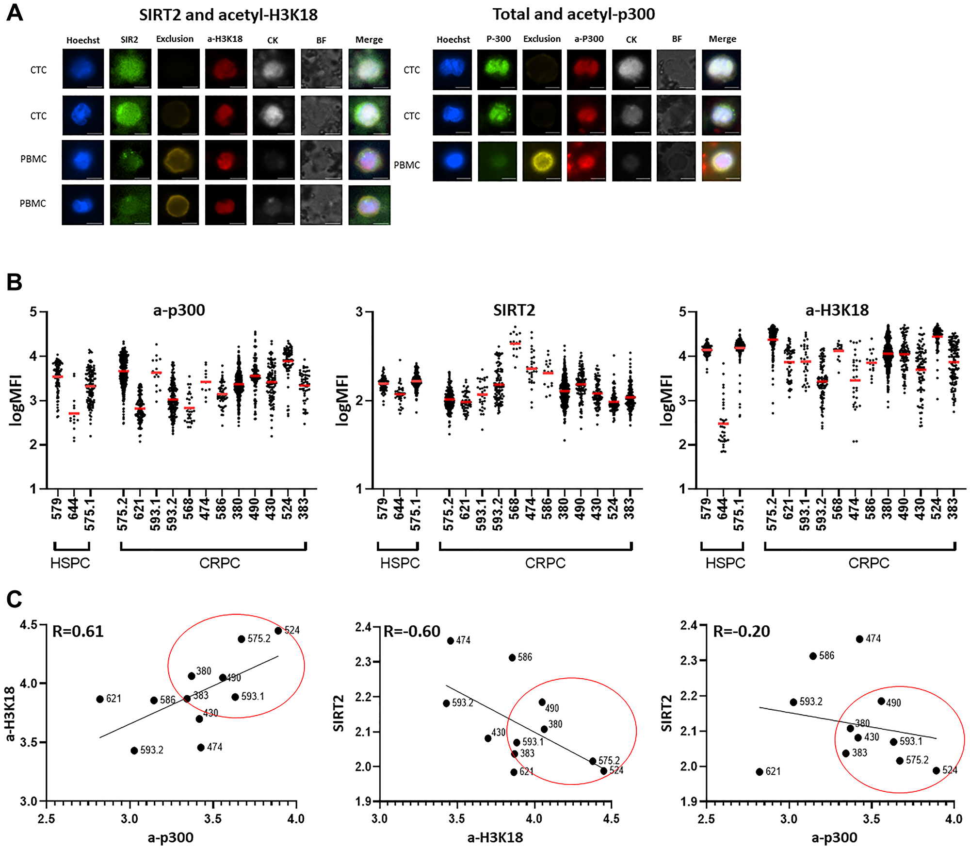Staining on CTCs in PC patients identifies a subset with increased acetyl-p300 and H3K18 and reduced levels of the deacetylase SIRT2