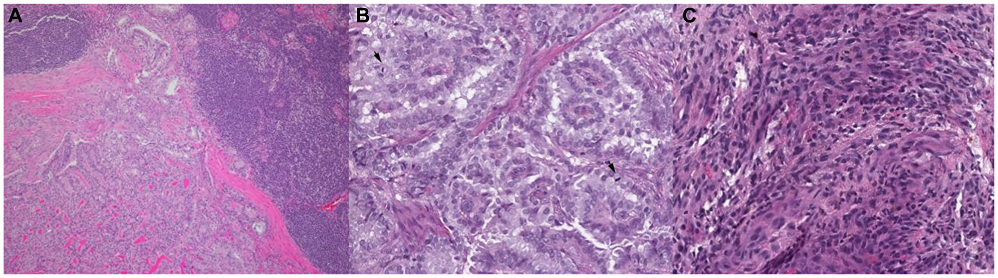 Representative histopathologic slides stained with hematoxylin and eosin of thyroid cancer from well-differentiated to dedifferentiated states