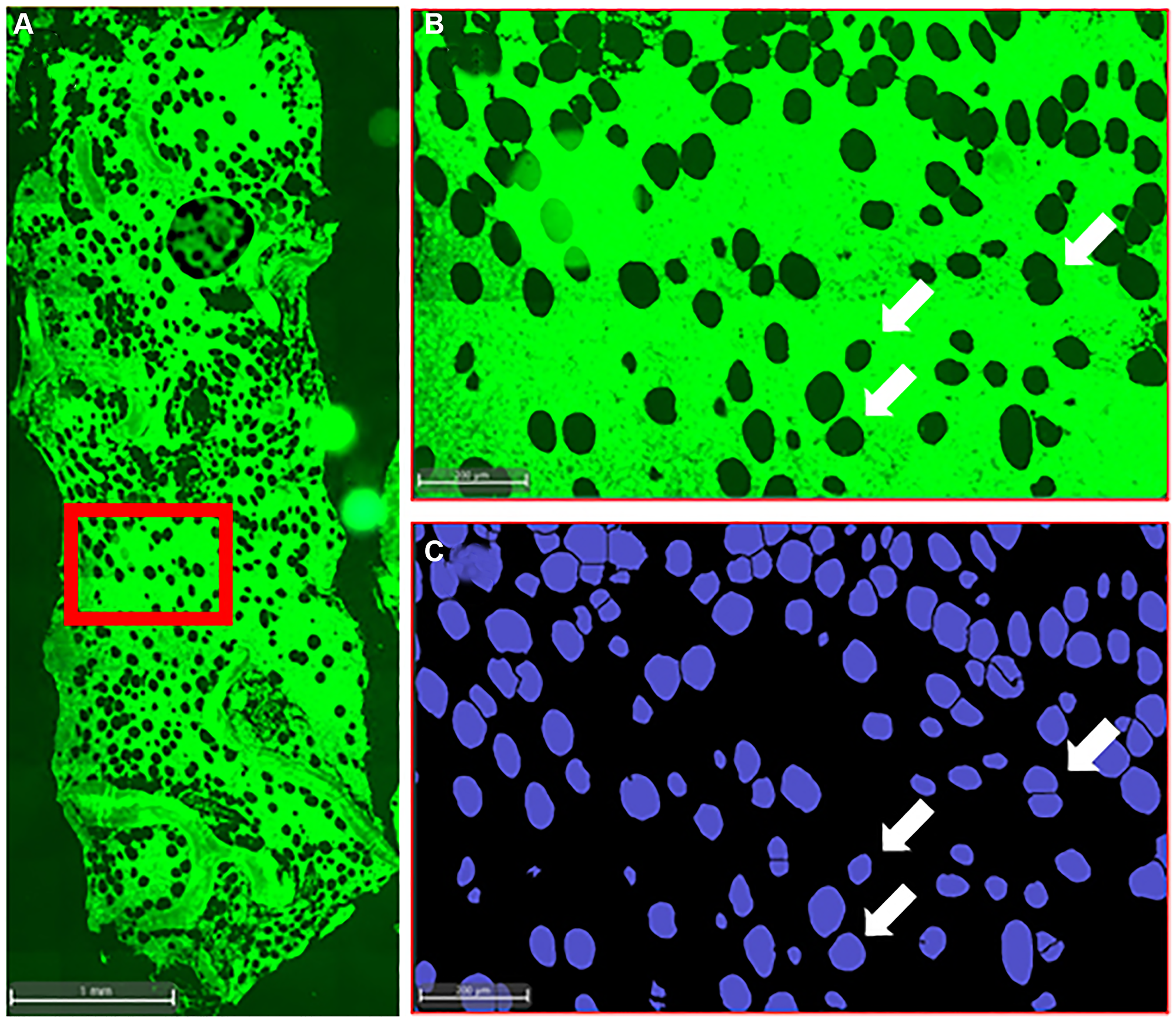 Histological analysis of iliac crest bone biopsy