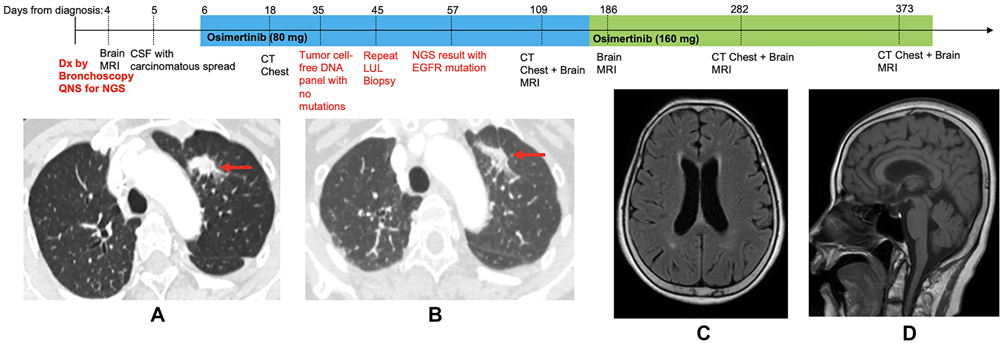 Treatment timeline with chest computed tomography (CT) and brain magnetic resonance images (MRI) on osimertinib