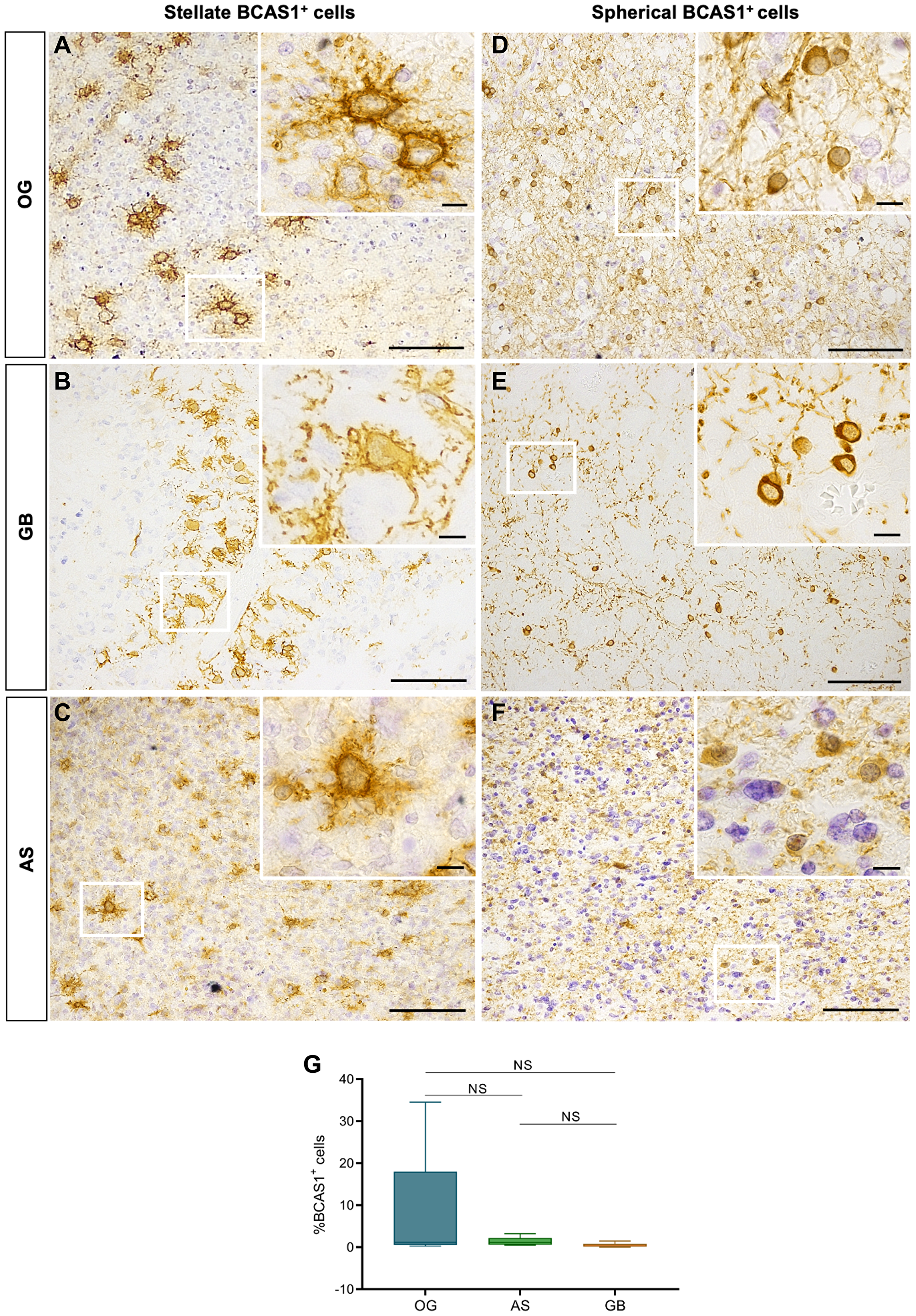 Diffuse gliomas BCAS1-expressing cells have two different morphologies