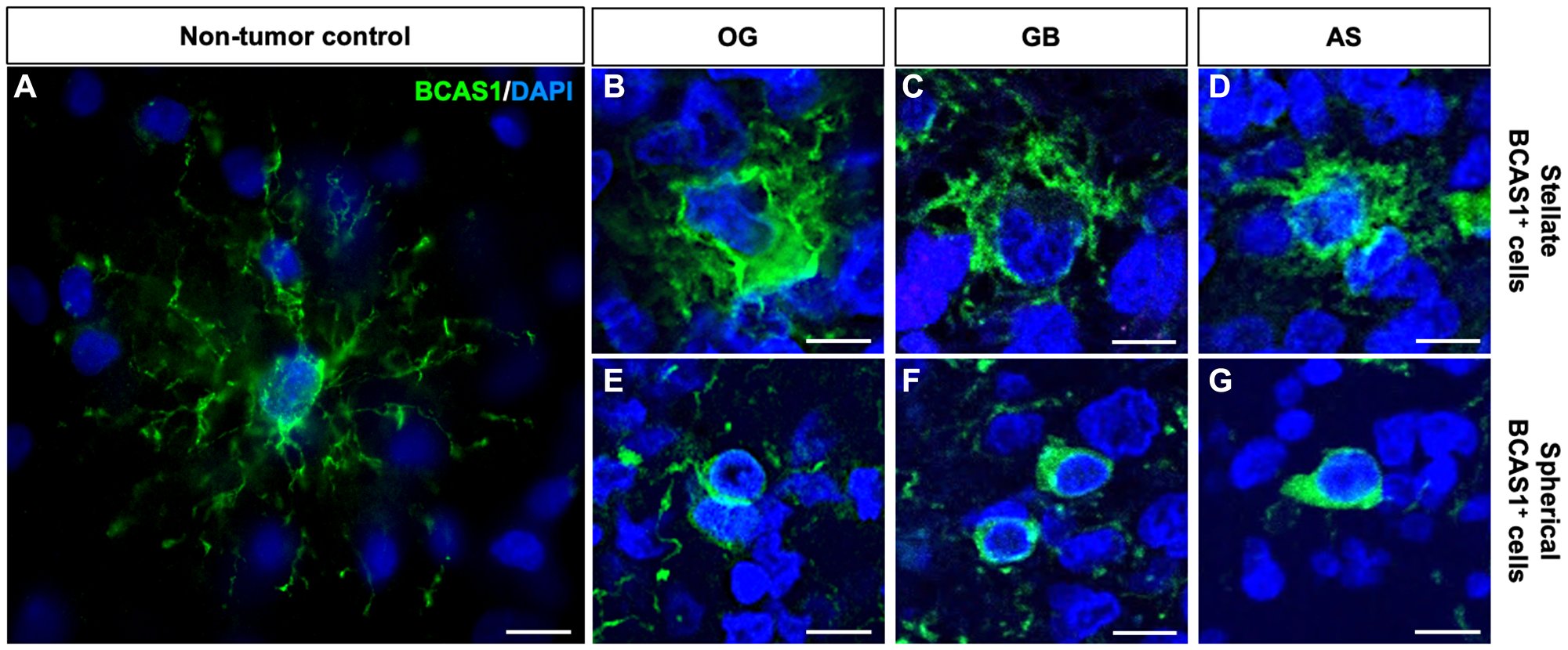 BCAS1+ cells in diffuse gliomas are morphologically different from BCAS1+ cells in healthy brain tissue