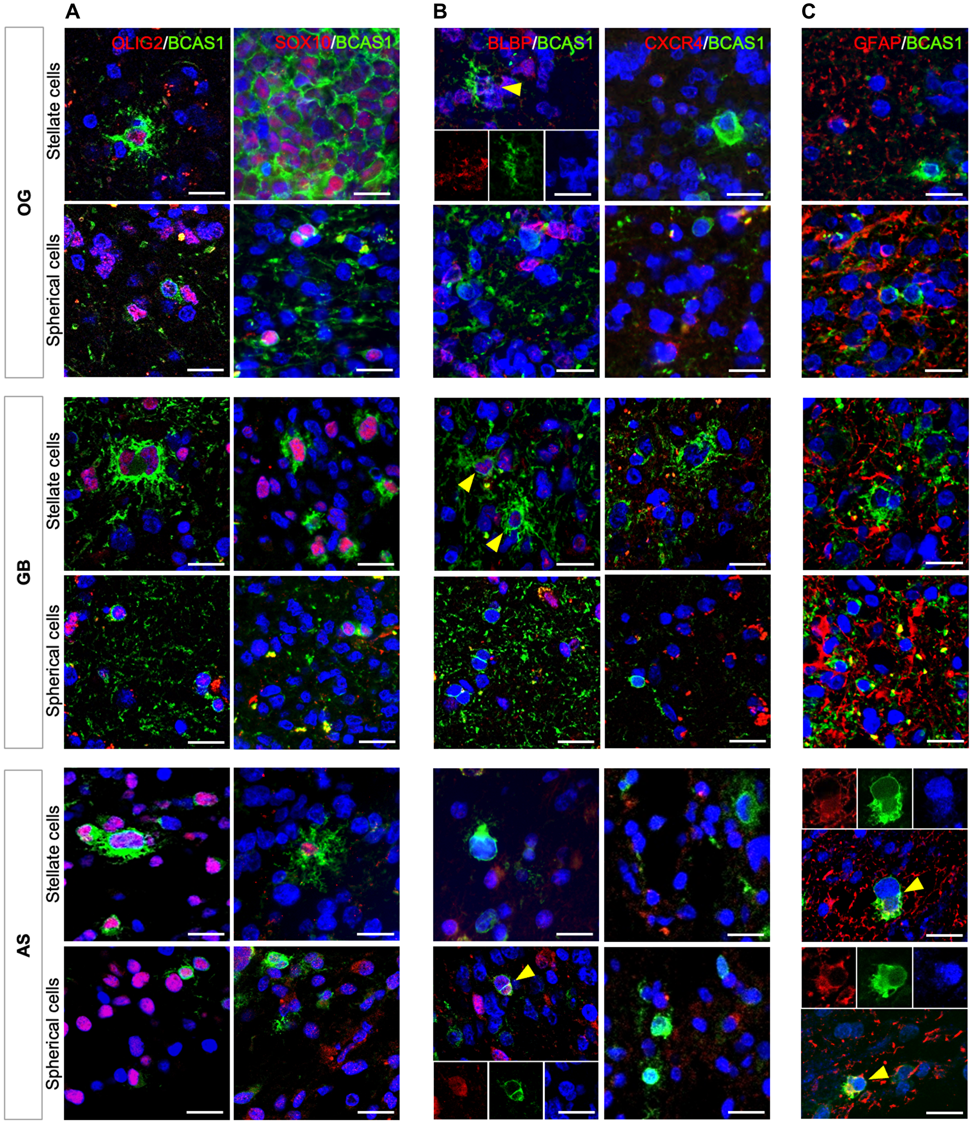 BCAS1+ cells share molecular characteristics in diffuse gliomas