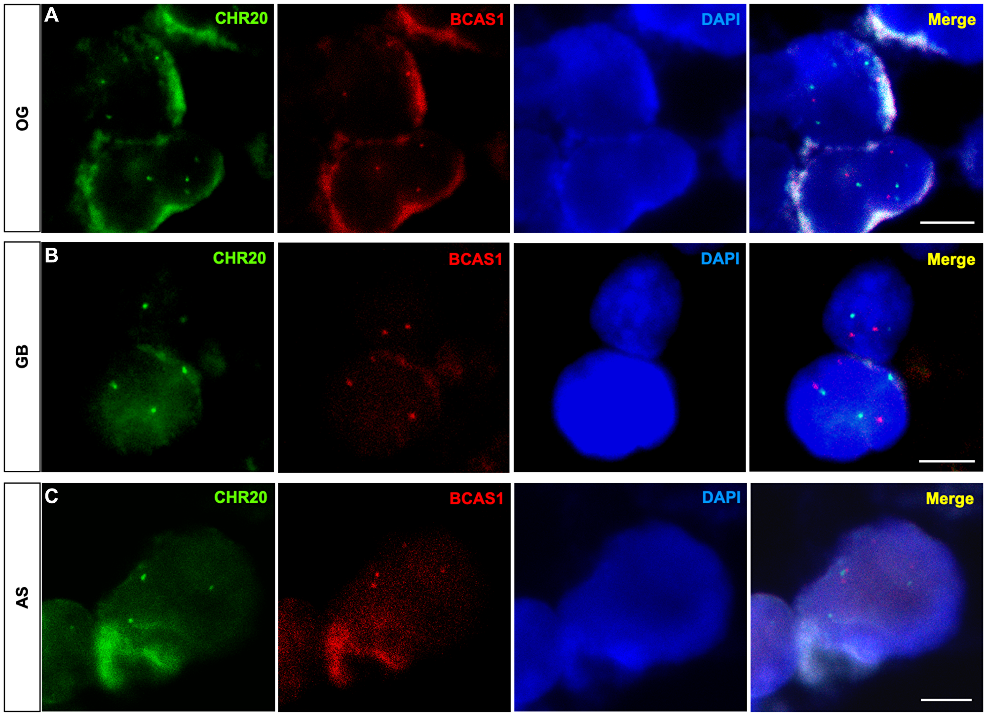Diffuse glioma cells exhibit numerical aberrations of chromosome 20 that harbors BCAS1 gene