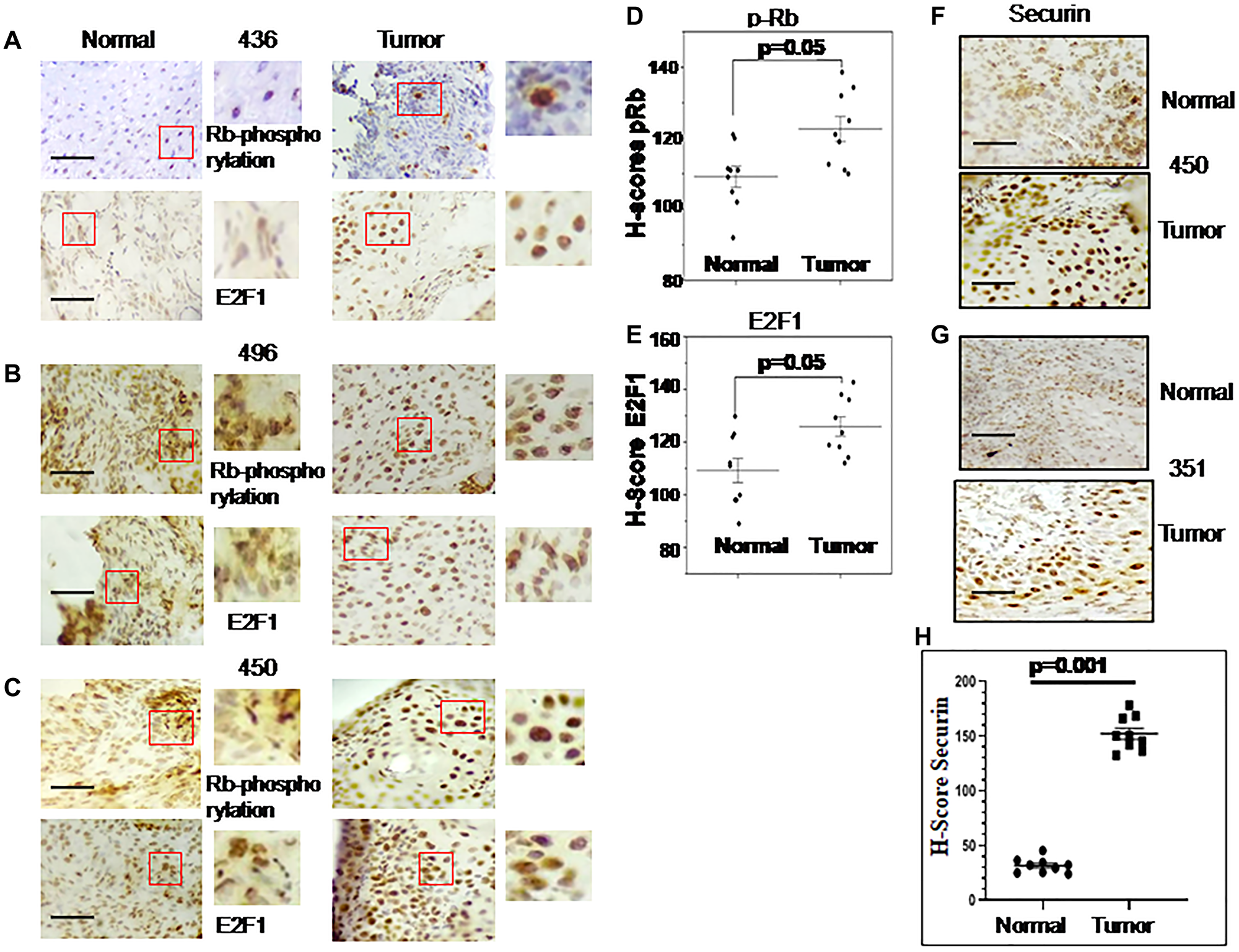 Immunohistochemical (IHC) images for Rb phosphorylation, E2F1 and securin gene expression in esophageal cancer and adjacent normal tissues