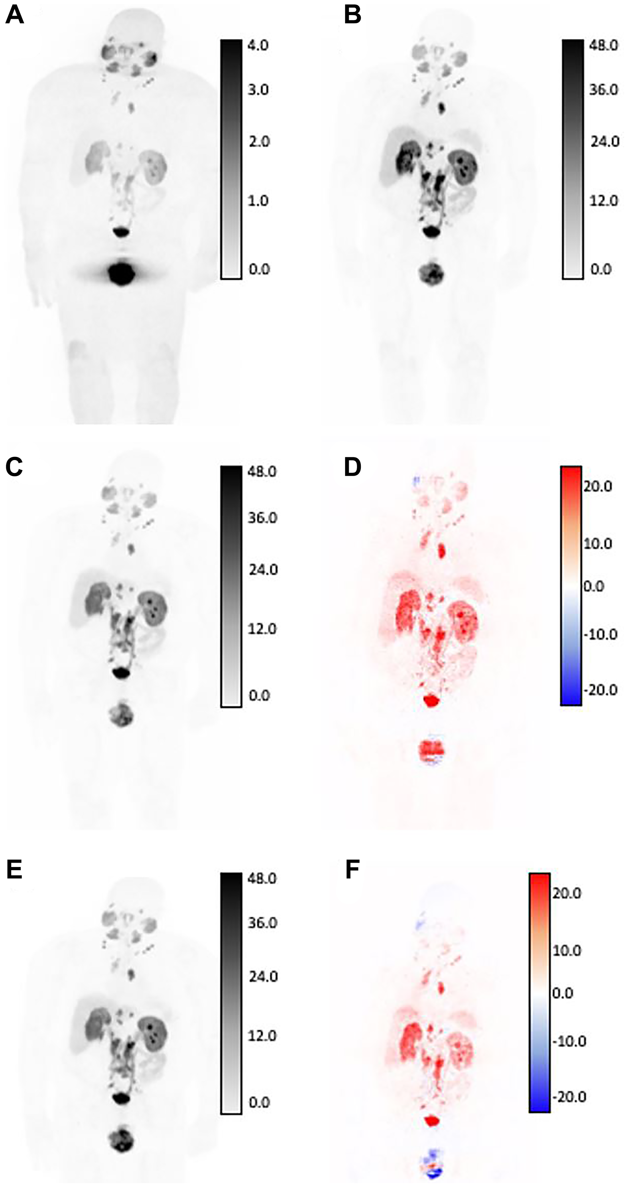 SUV differences between GAN outputs and original AC-PET, shown in coronal view for patient with high tumor burden by expert assessment