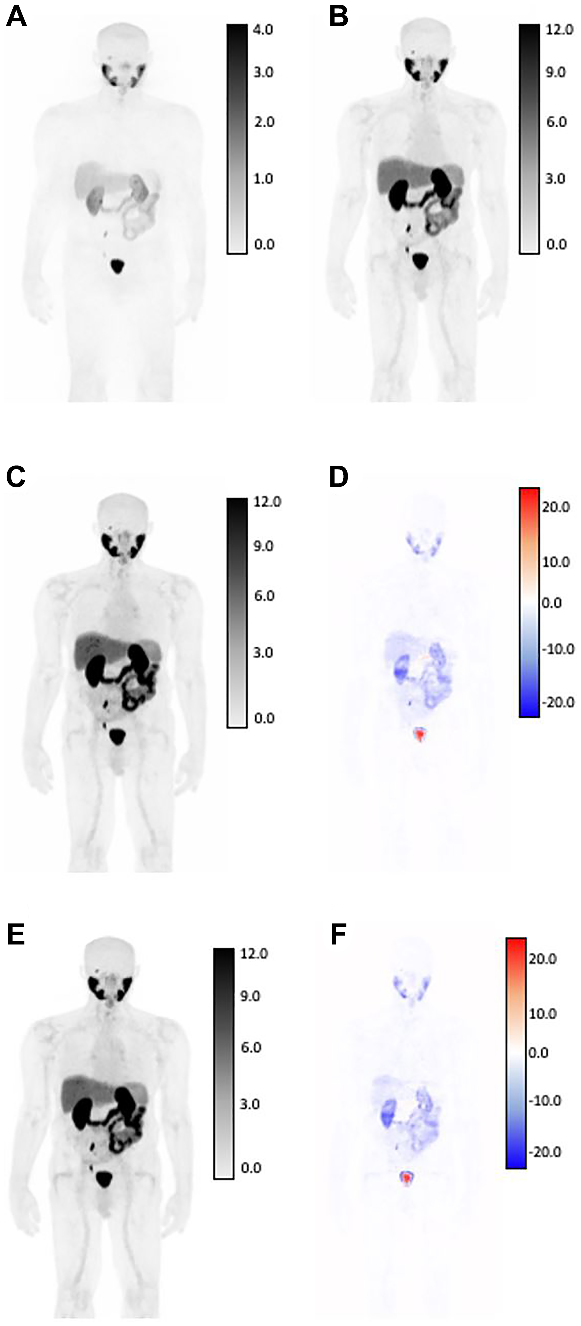 SUV differences between GAN outputs and original AC-PET, shown in coronal view for patient with low tumor burden by expert assessment