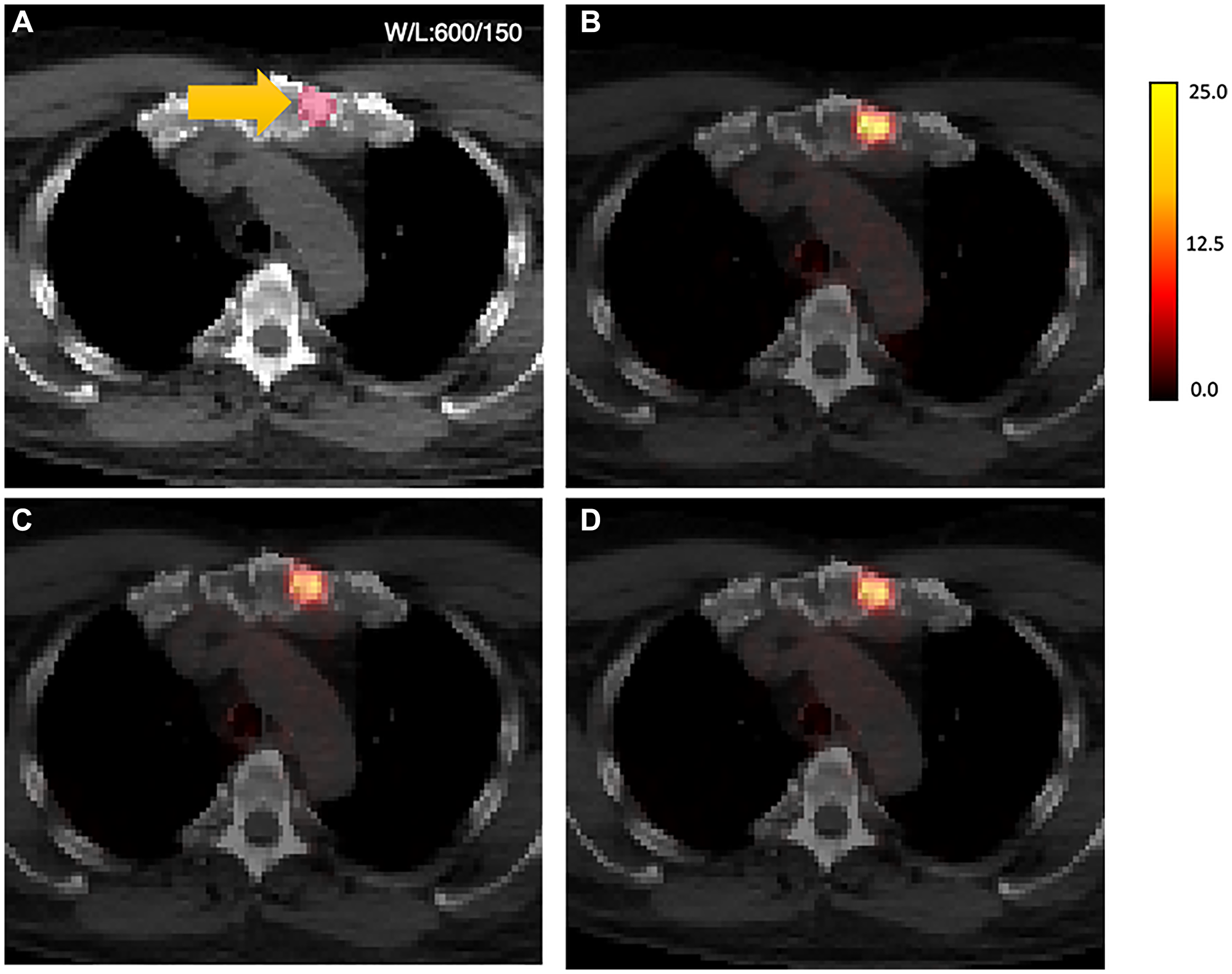 AI-generated PET results shown overlaid on CT