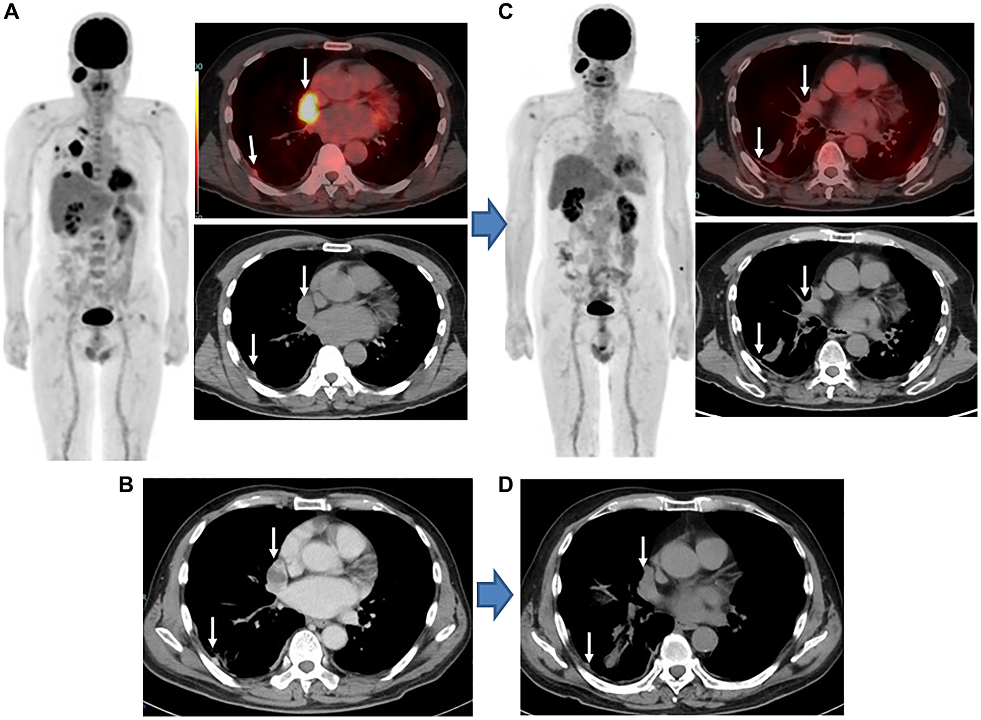 Sarcomatoid MPM, stage IB (cT3N0M0), man, 70 years old