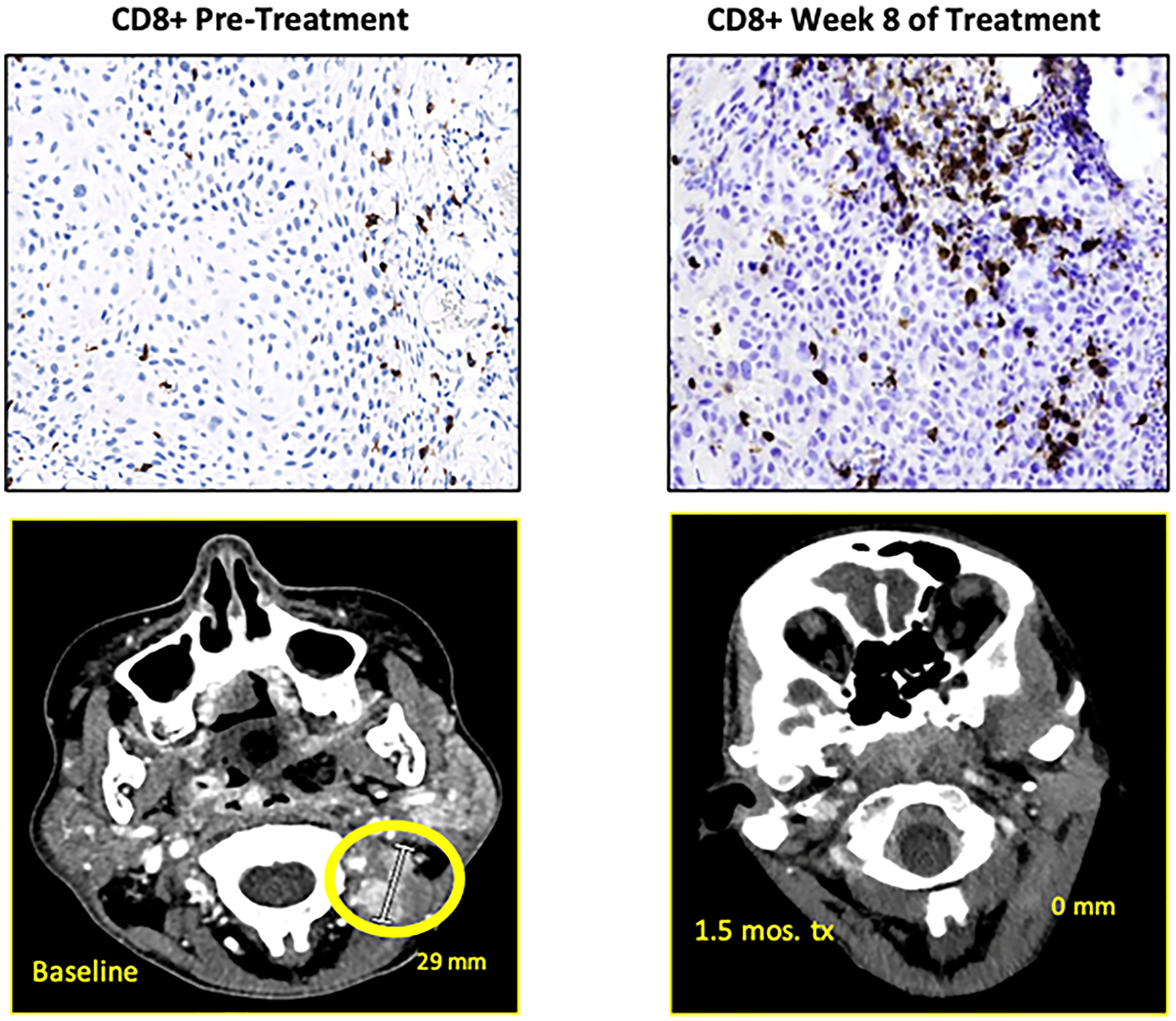 Baseline and on-therapy imaging and biopsy results showing radiographic resolution of tumor and increase of intratumoral COB+ cells
