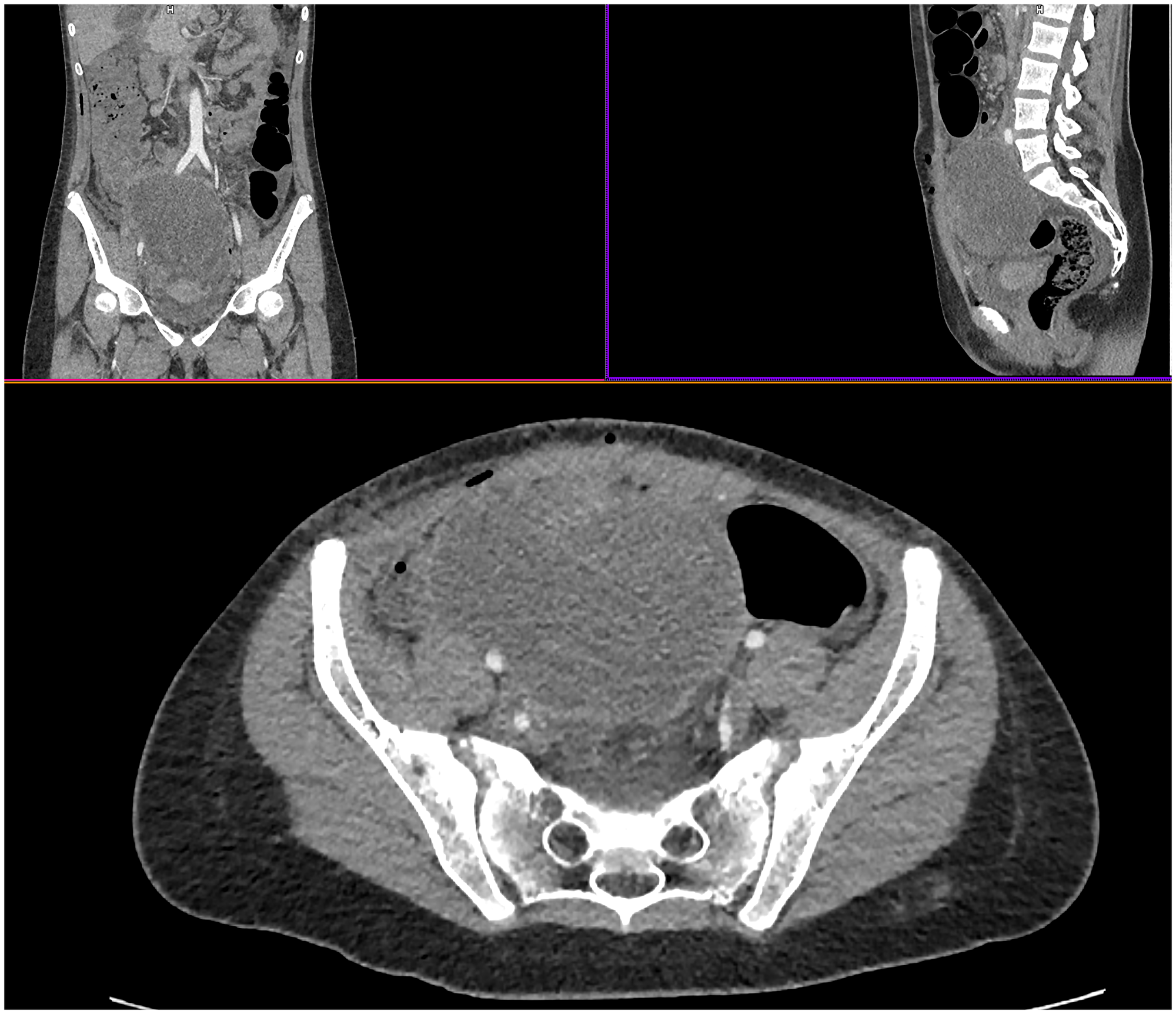 A multislice computed tomography of the original tumor