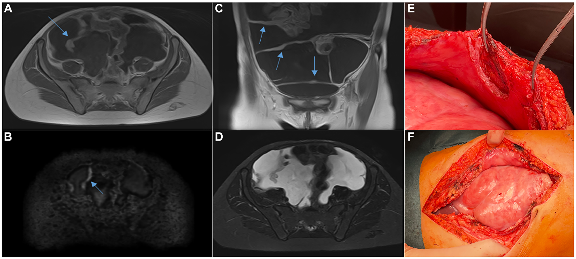 Peritoneal carcinomatosis during disease progression on immunotherapy