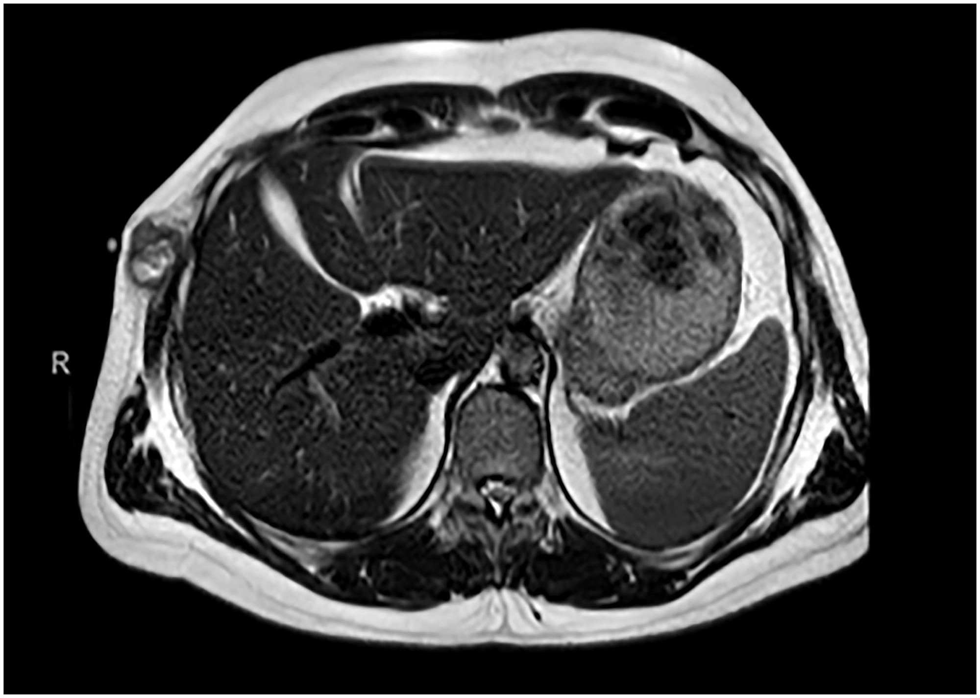 Chest MRI 04/22/2021