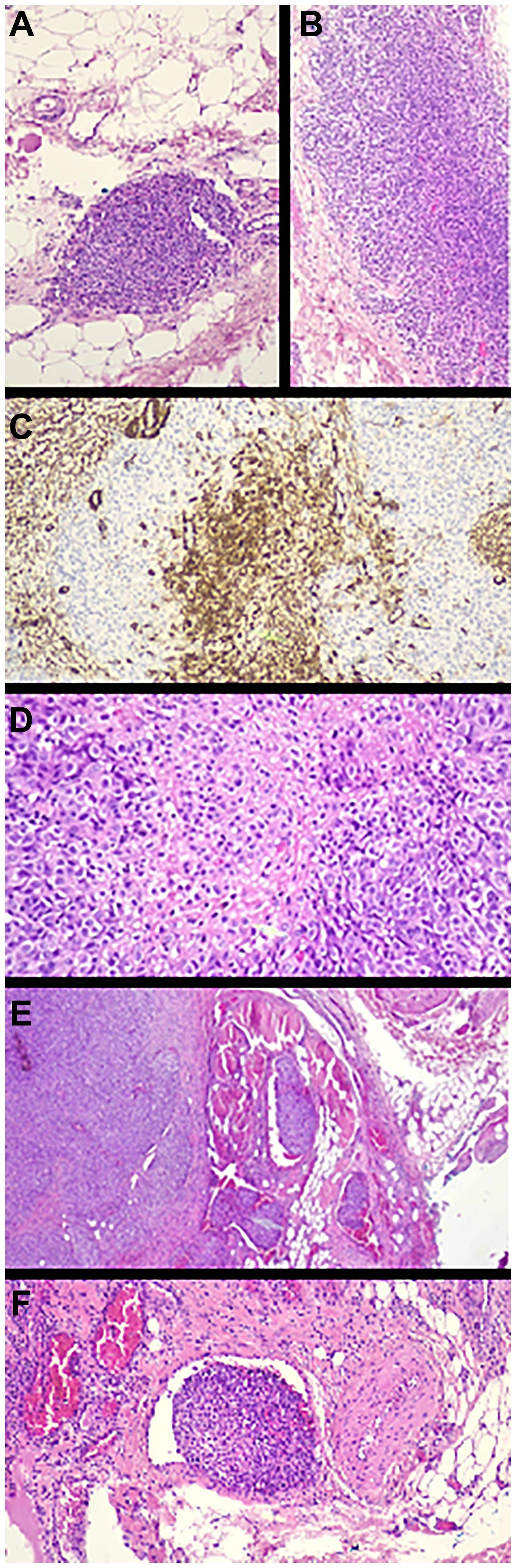Pathology images (A–D). Immunohistochemistry staining. Histologically, a well-demarcated, unencapsulated, multinodular, densely cellular neoplasm is observed, that grows forming large nodules composed of cells of epithelioid morphology with well-demarcated, broad, eosinophilic or amphophilic cytoplasm, with nuclei with fine chromatin, some of them with presence of eosinophilic nucleolus growing in subcutaneous cellular adipose tissue with images of tumor necrosis and vascular invasion. There are 12 mitoses per 10 high-power fields. The tumor is associated with vascular structures with large areas of blood extravasation and hemosiderophages. The tumor infiltrates the included striated muscle tissue and the surgical resection margin. Transition is identified between well-differentiated low-grade areas (benign glomus tumor) and the predominant high-grade tumor. Immunohistochemical profile was: Actin ML (focal), Actin HHF35, H-caldesmon and Collagen IV (characteristic pericellular and diffuse pattern), p16 (predominantly cytoplasmic) positive; CKAE1-AE3, CK19, Myogenin, Desmin, S100, HMB45, MELAN-A, CD34, CD31, ERG, FACTORVIII, CD138, EMA, CD68, TFE3, D2-40 and HHV8 negative. (A) Hematoxylin-eosin (HE) X 10. Peripheral focus of benign glomus tumor. (B) HE X 10. Peripheral focus of benign glomus (larger diameter). (C) IHC X 10. Patchy positive staining for ML-Actin. (D) HE X 20. Solid tumor growth on a collagenous stroma. The cells are of epithelioid morphology with clear or amphophilic cytoplasm very well demarcated and enlarged oval nuclei with fine chromatin. (E) HE X 5. Low magnification, in the periphery of the tumor two images of venous vascular invasion and infiltration of the included adipose and striated muscle tissue are observed. (F) HE X 20. Venous vascular tumor invasion.