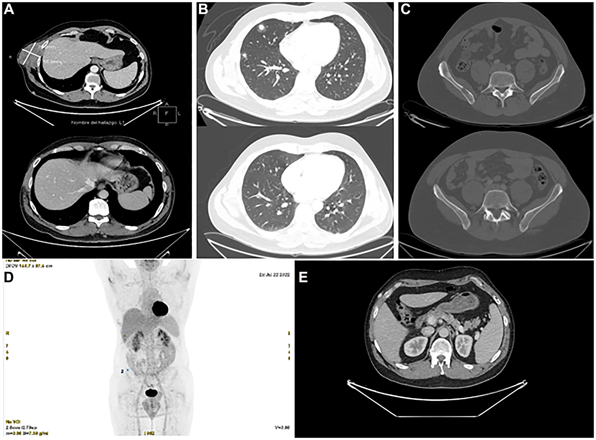 Radiological evolution after targeted therapy