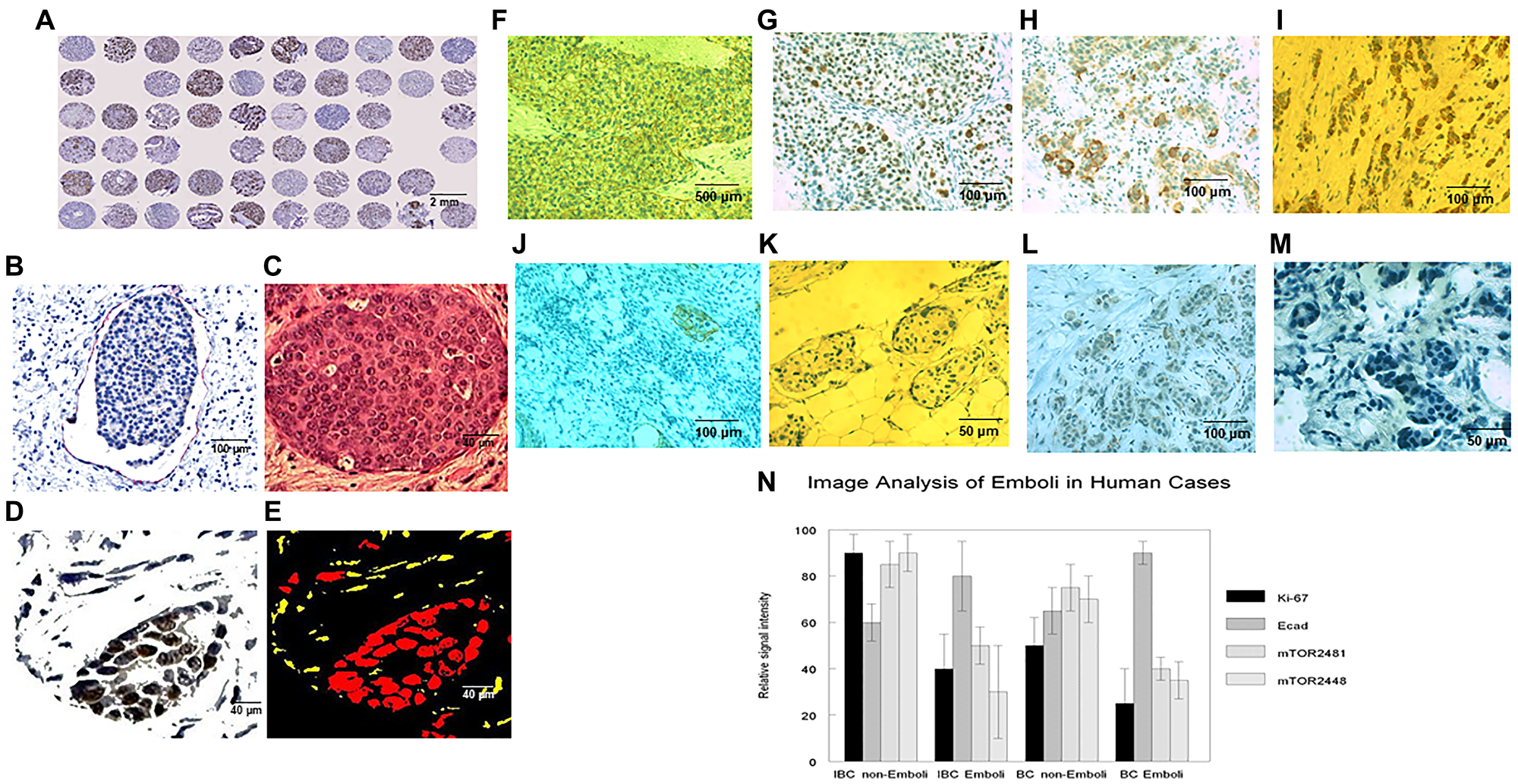 Image and algorithmic analyses of multiple histological and immunocytochemical parameters in emboli v non-emboli in IBC and non-IBC cases