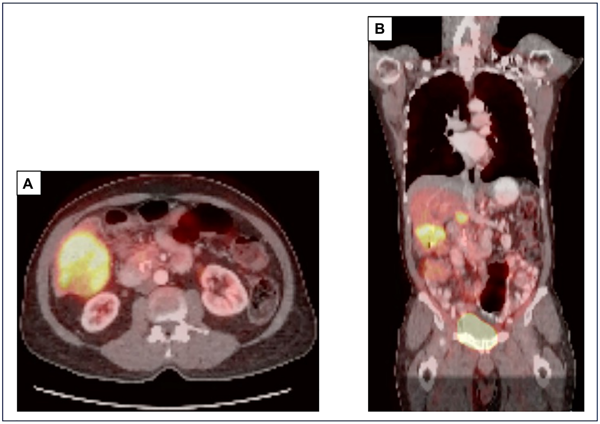 PET-CT scan at our institution prior to staring sotorasib demonstrates an 8.2 cm mass in the right inferior lobe of the liver with a SUV of 10.8 (A, B) and a 2.7 cm pancreatic head mass with a SUV of 5.8 (B). Abbreviations: PET: positron emission tomography; CT: computed tomography.