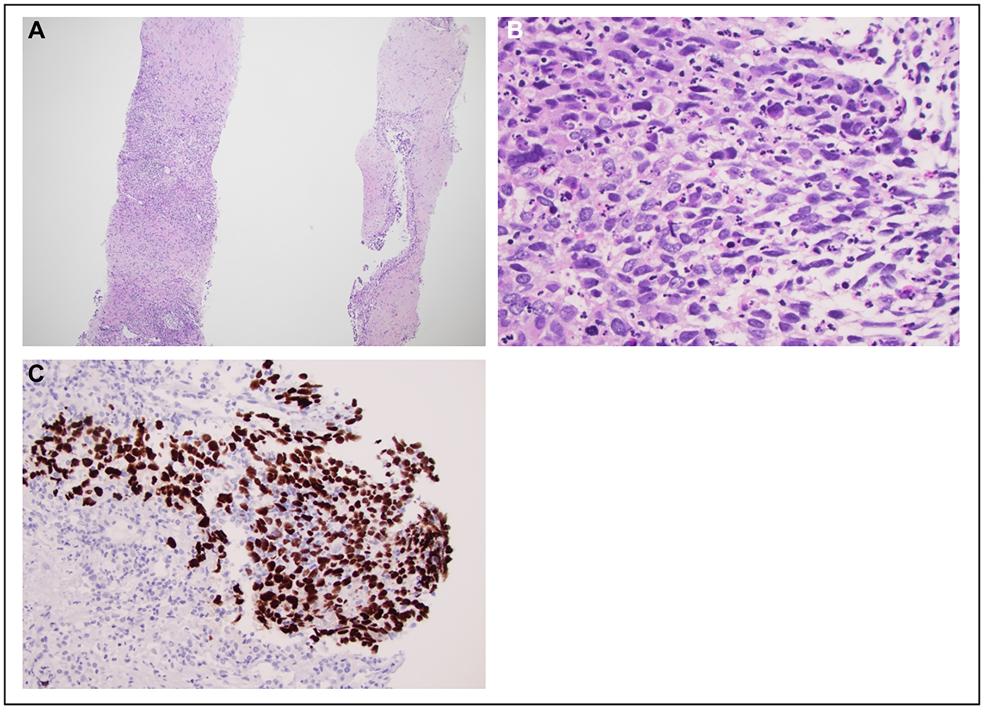 Histopathological and imrnunohistochemical images of a core biopsy of the liver lesion