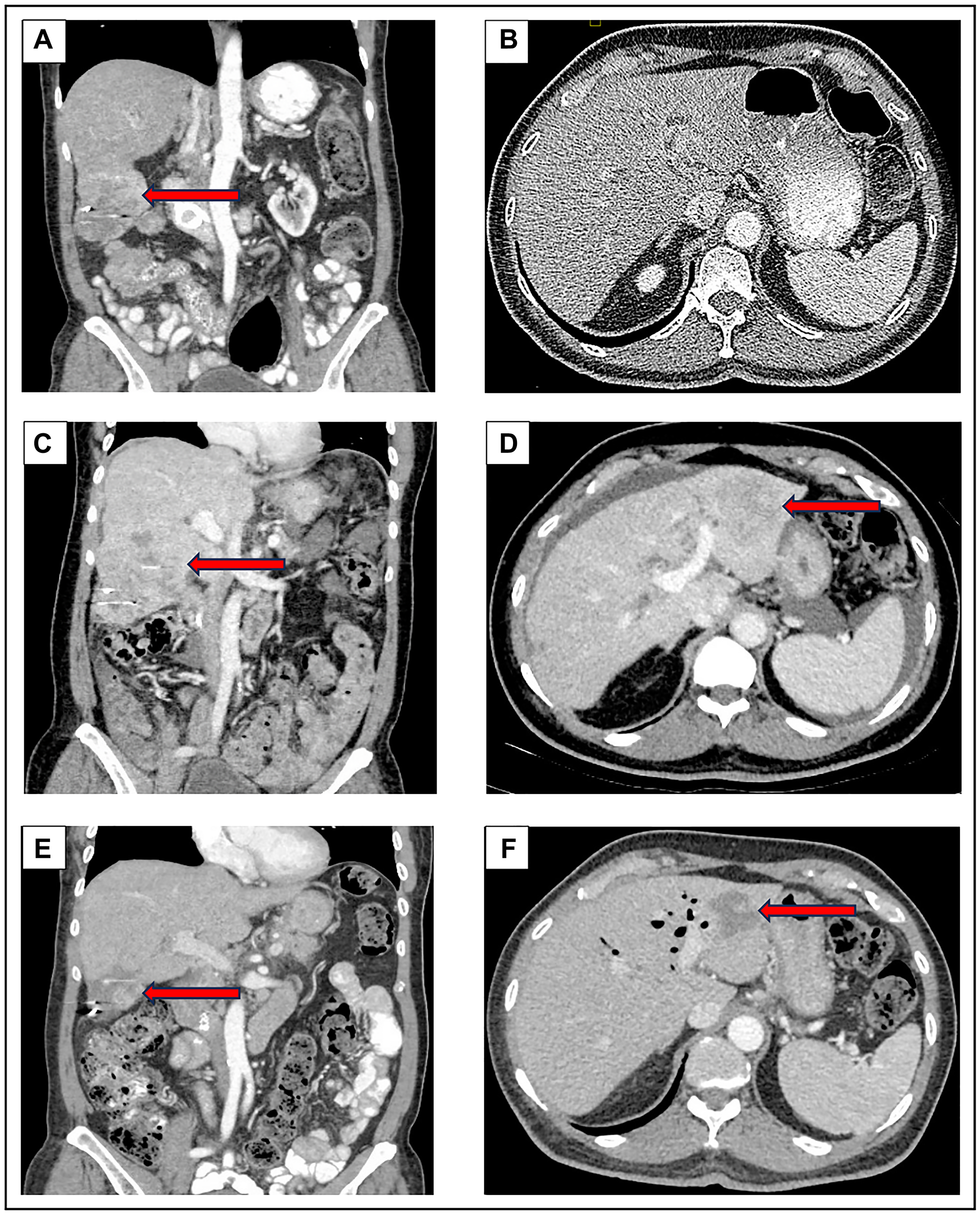 CT Scan on initial presentation to our institution in October 2022 (A, B) demonstrated a right lobe liver lesion measuring 8.2 cm in greatest dimension. In April 2023 (C, D), after six months of treatment with sotorasib, there was an increase in the right lobe liver lesion to 10.2 cm along with a new left lobe lesion measuring 5 cm. In July 2023 (E, F), after four cycles of pembrolizumab, the right lobe liver lesion reduced in size to 5.7 cm and the left liver lobe lesion decreased to 3.5 cm.