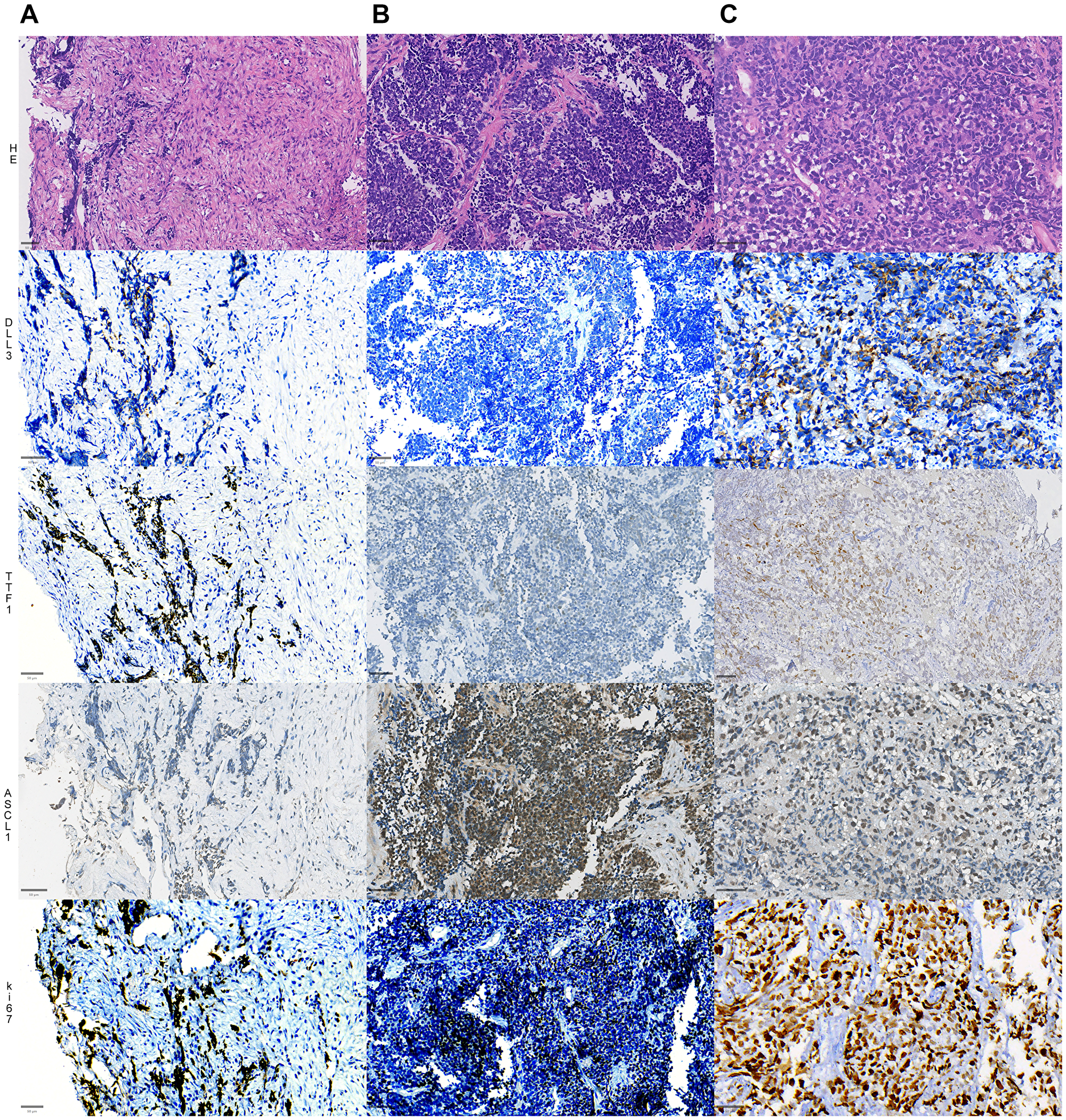 Representative slides of 3 different cases of SCLC (A–C), showing distinct morphology (top panel, HE sections) and expressions of DLL3 in the second row, TTF1 in the third row, ASCL1 expression in the fourth row and ki67 index in the fifth and final row. The first cases (1st column) shows a moderate expression of DLL3, strong positivity for TTF1, weak and focal positivity for ASCL1; the second case (second column) shows negative DLL3, negative TTF1, strong and diffuse nuclear expression for ASCL1, while the third case (3rd column) shows strong positivity for DLL3, TTF1 and ASCL1. All cases show a high ki-67 proliferative index. Bars = 50 µM (micrometers).