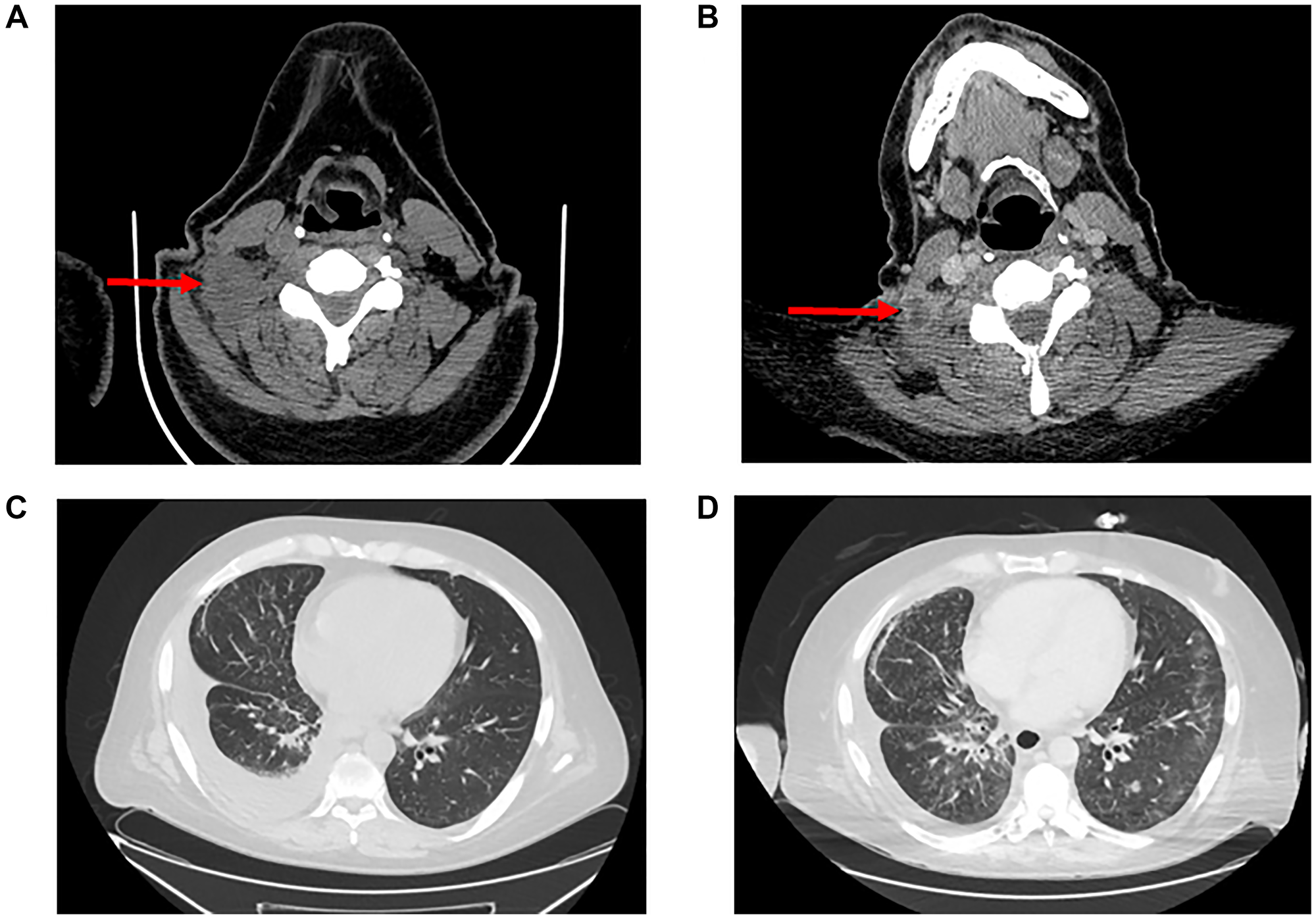 Radiographic response imaging to pralsetinib plus lorlatinib