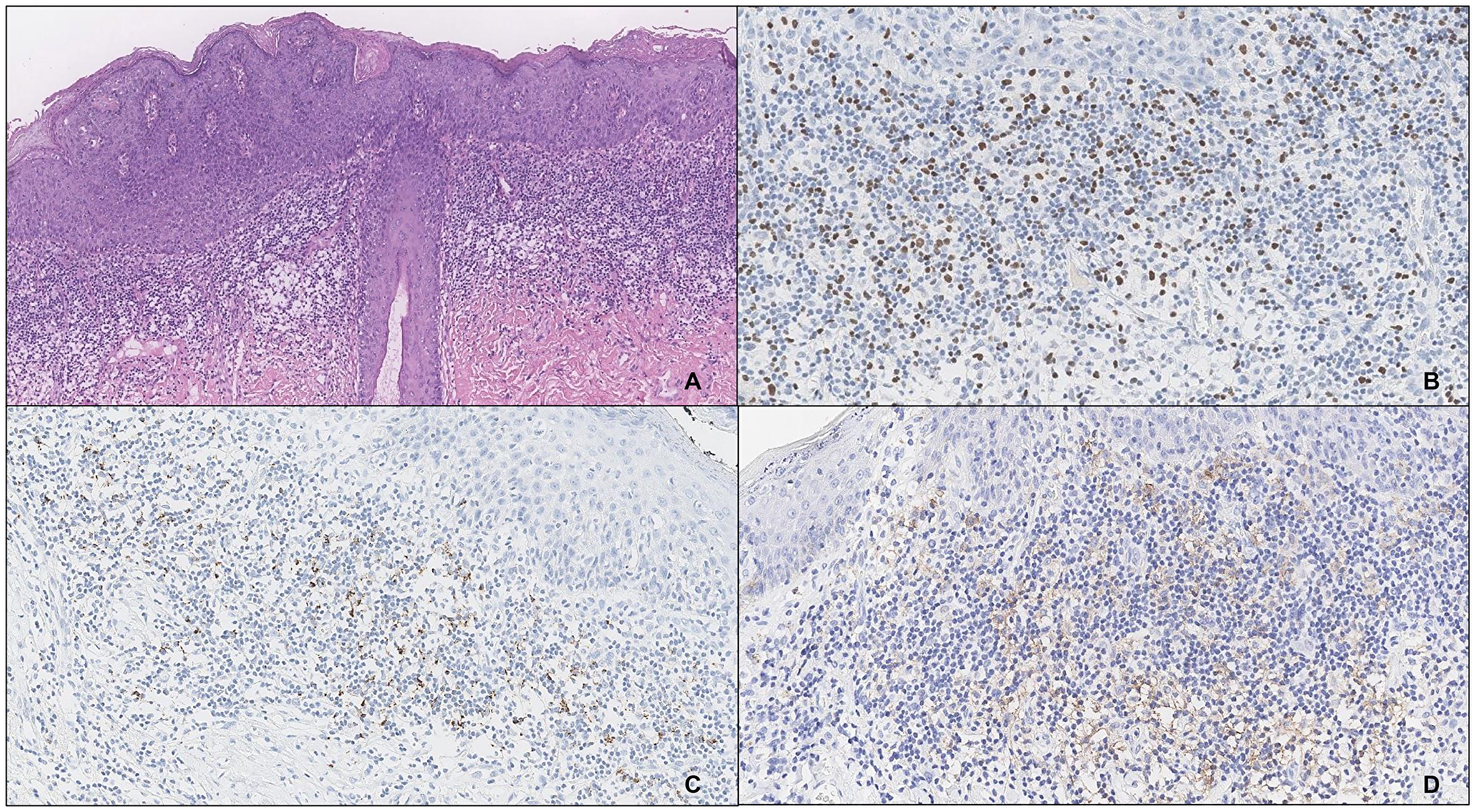 An example of vulvar HSIL with type 2 inflammatory infiltrate (A), high counts of FOXP3+ cells (40x) (B) and expression of PD-L1, SP142 (C) and 22C3 (D) in the IC.