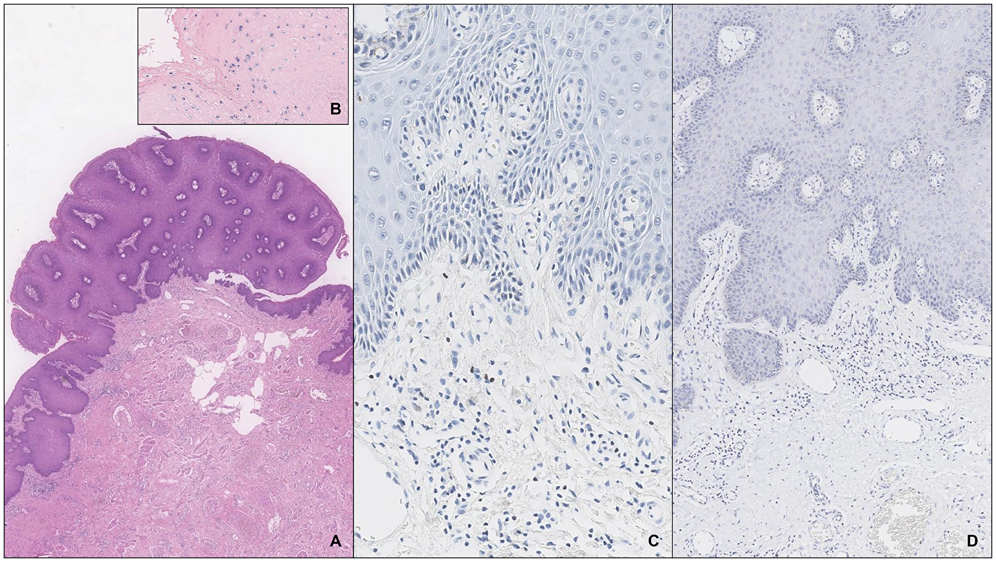 A penile condilomatous LSIL with type 0 infiltrate (A) and coinfection with HR-HPV by ISH (B). There are rare FOXP3+ cells (C) and no expression of PD-L122C3 (D).