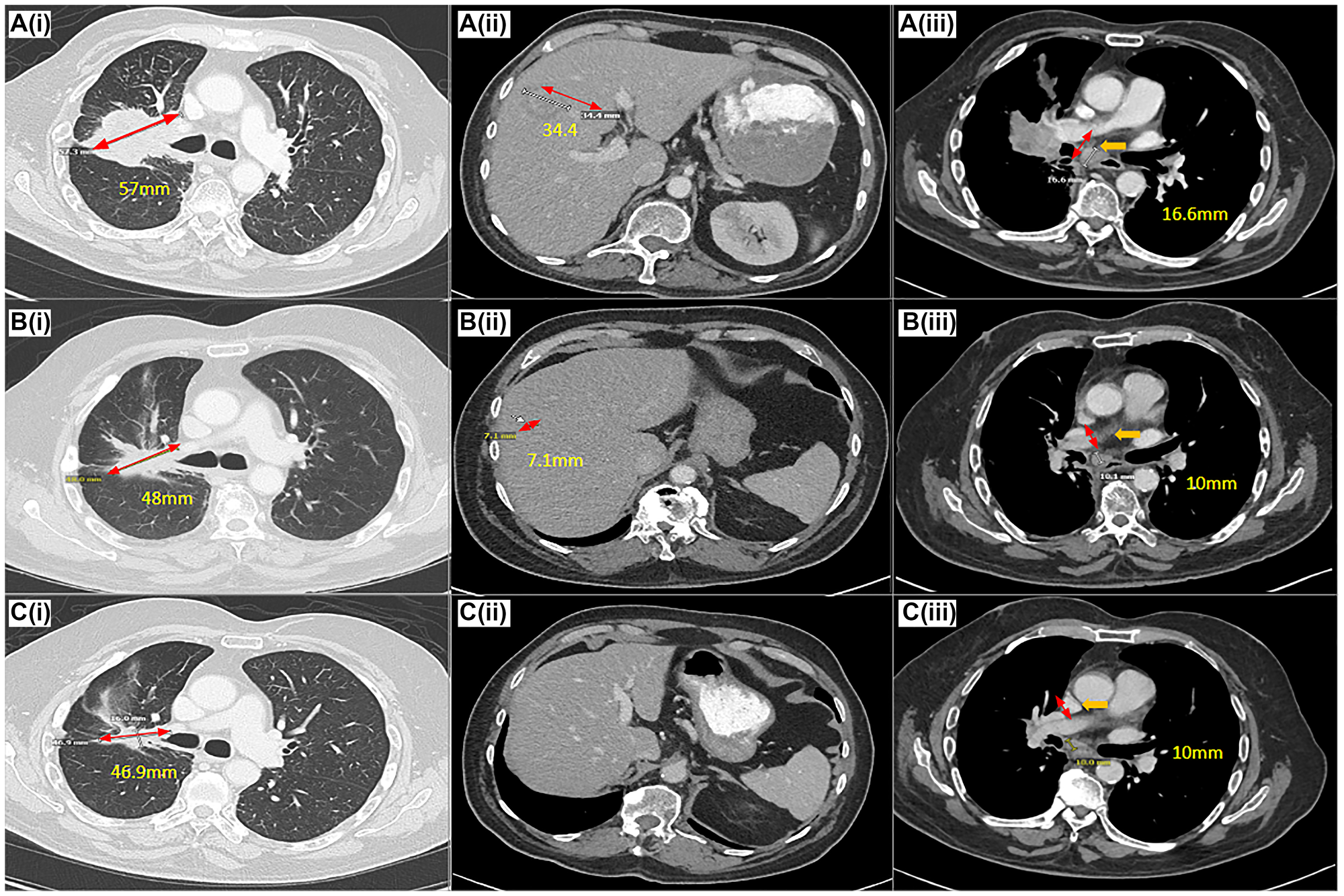 Target response on amivantamab based on RECIST 1.1 on CT scan