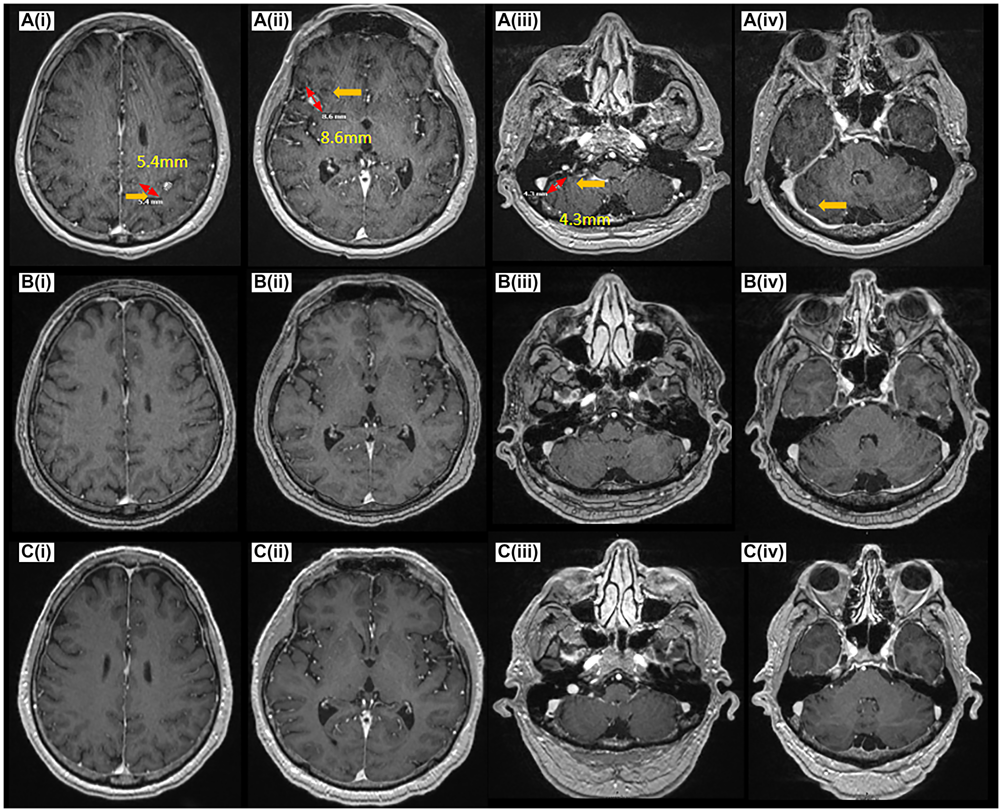 CNS disease response on amivantamab