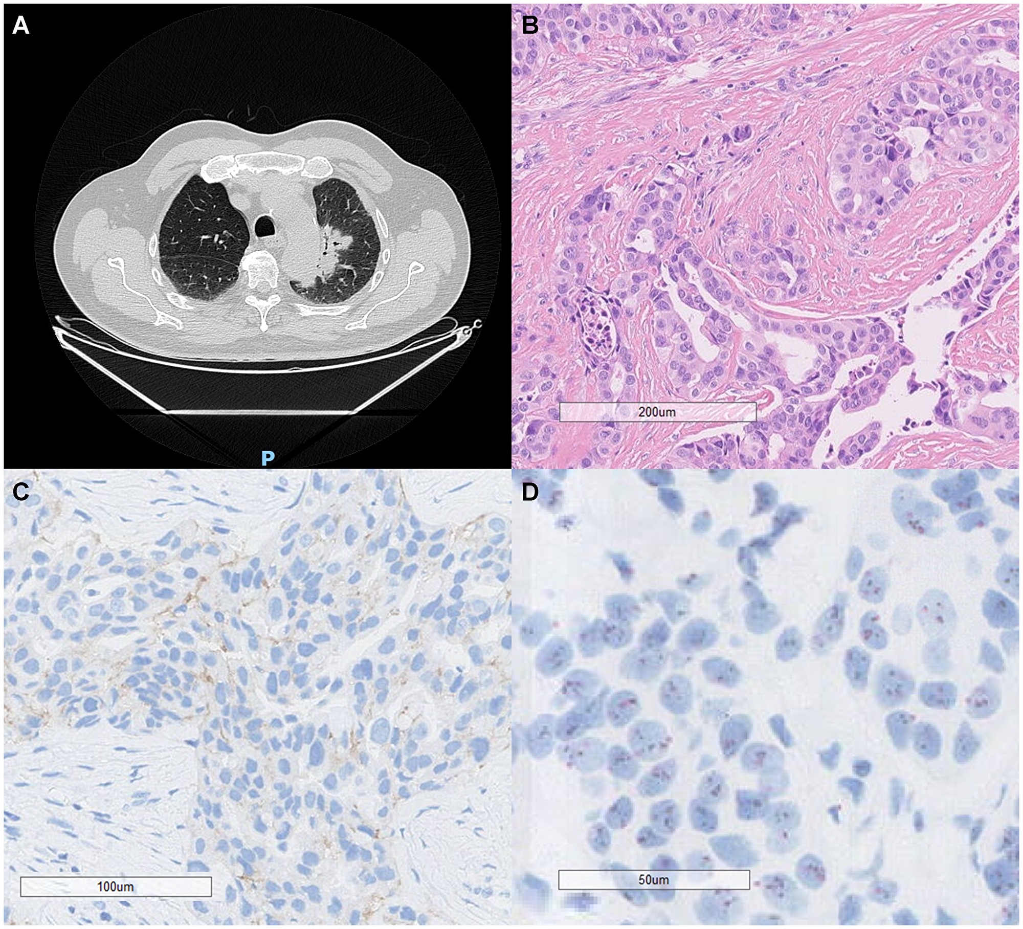 Radiological, histopathological, and molecular features of a HER2-amplified lung adenocarcinoma