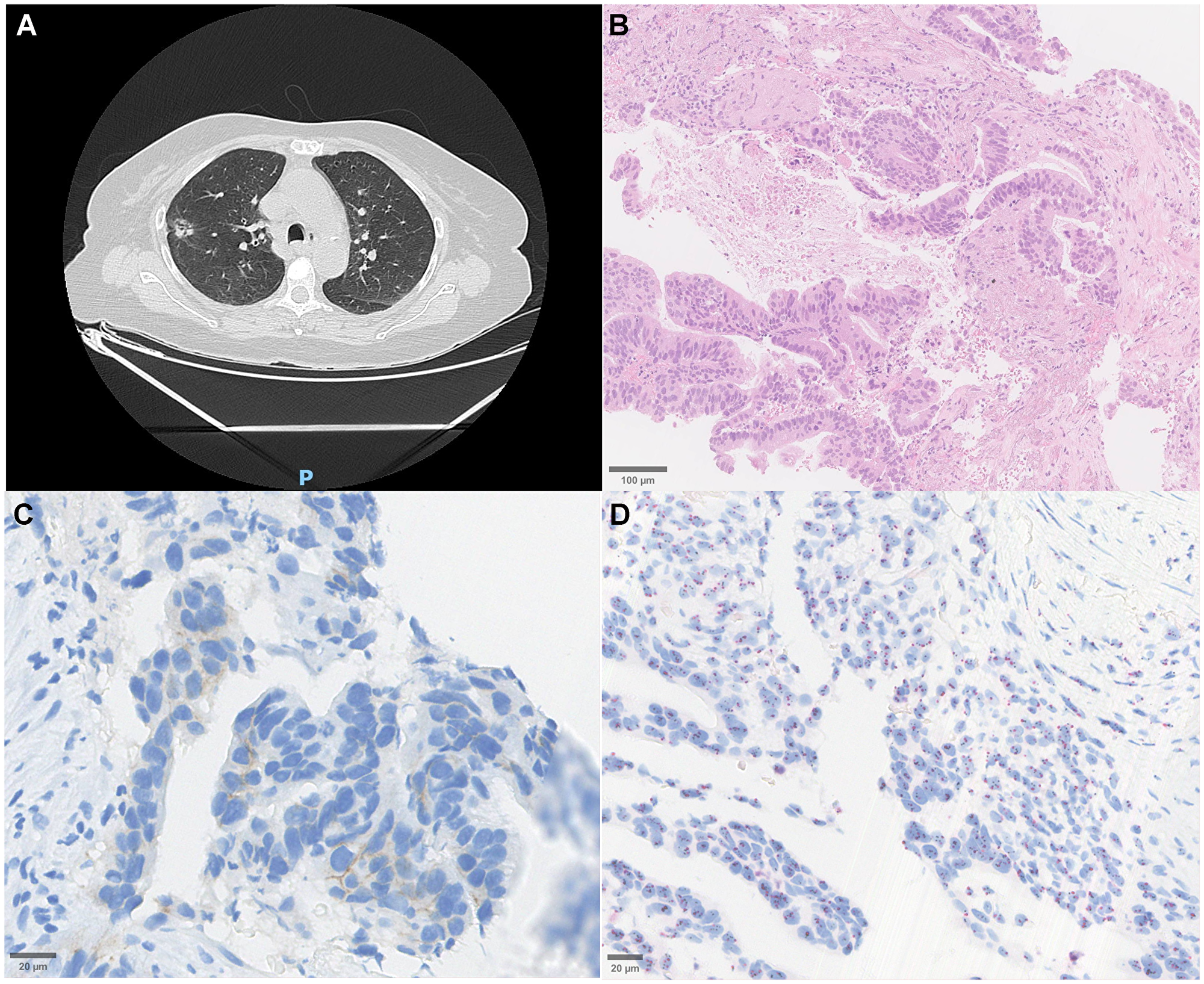 Radiological, histopathological, and molecular features of a HER2 non-amplified lung adenocarcinoma